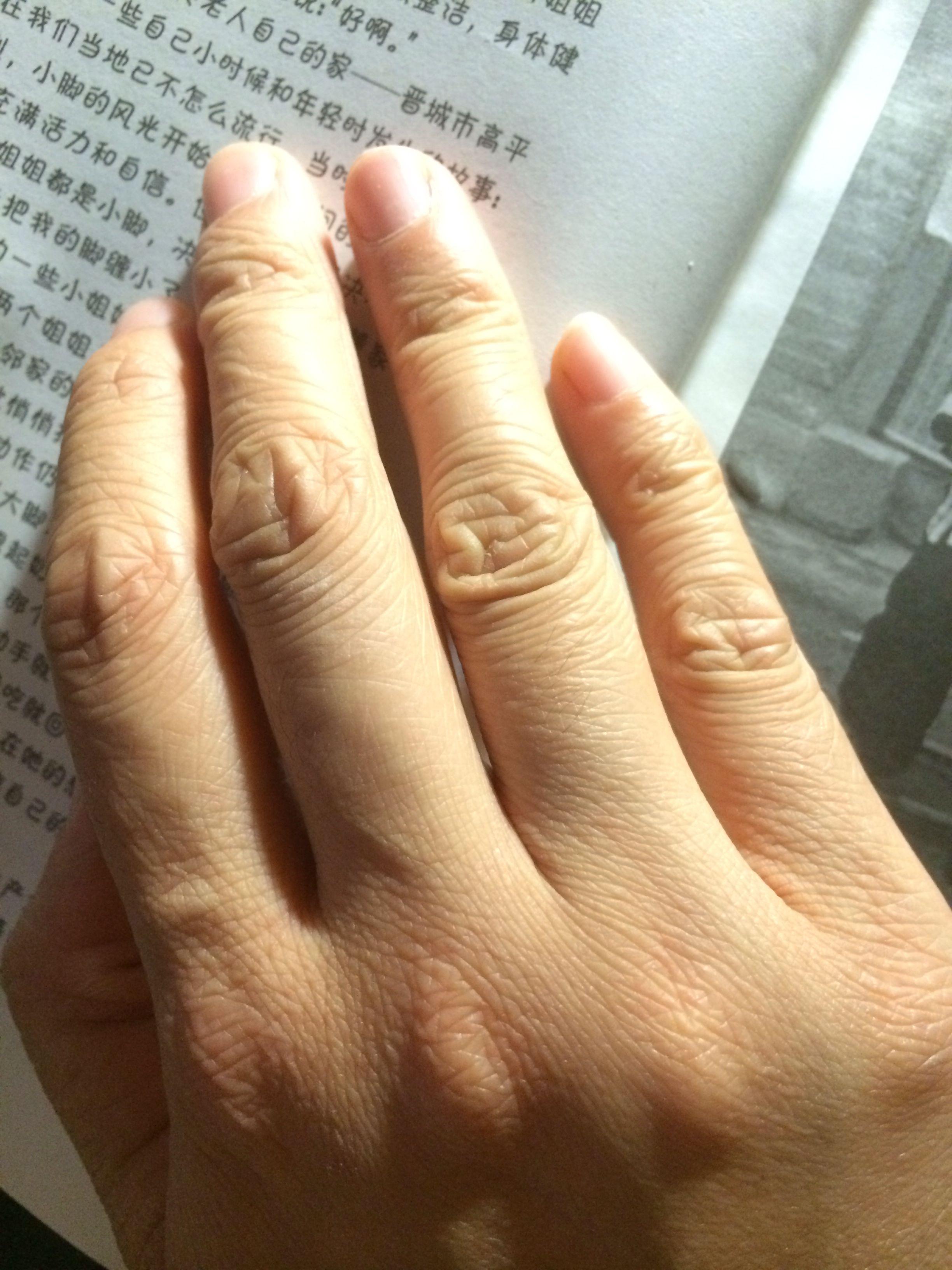 年纪轻轻23岁手上皮肤就很干有很多皱纹,像老年人干瘪的手,怎么办呀?