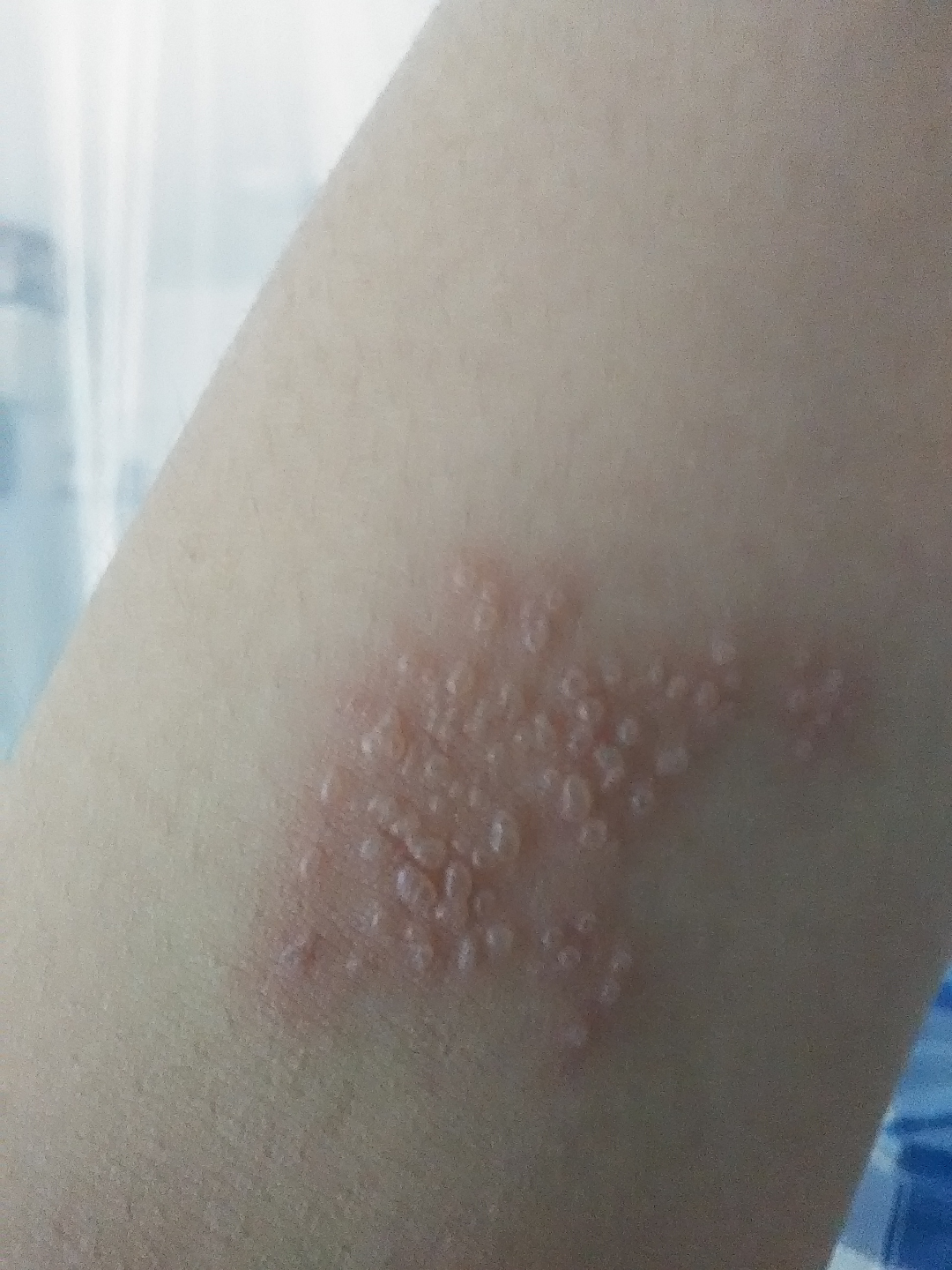 这是湿疹还是疱疹