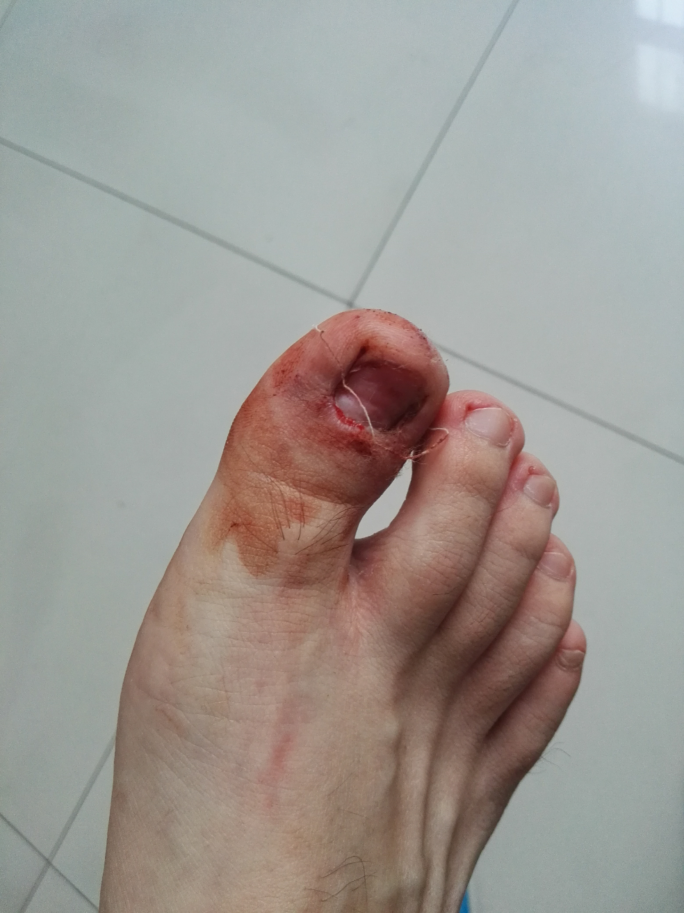 拔指甲是什么样的体验?很疼么? - 知乎