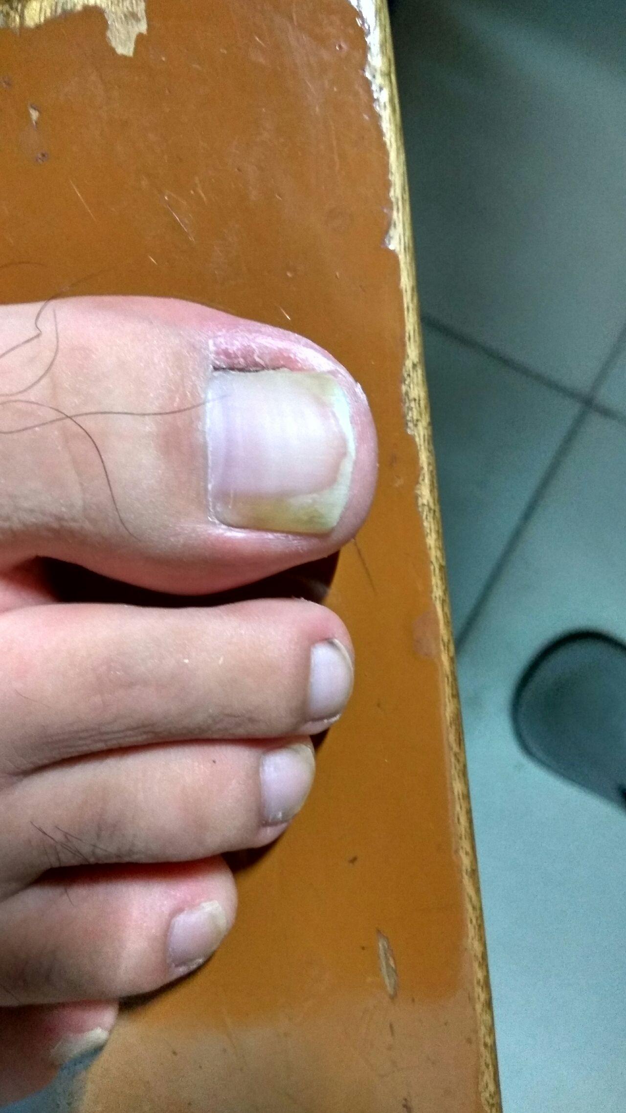 我脚趾甲右侧发黄变厚,是灰指甲吗?