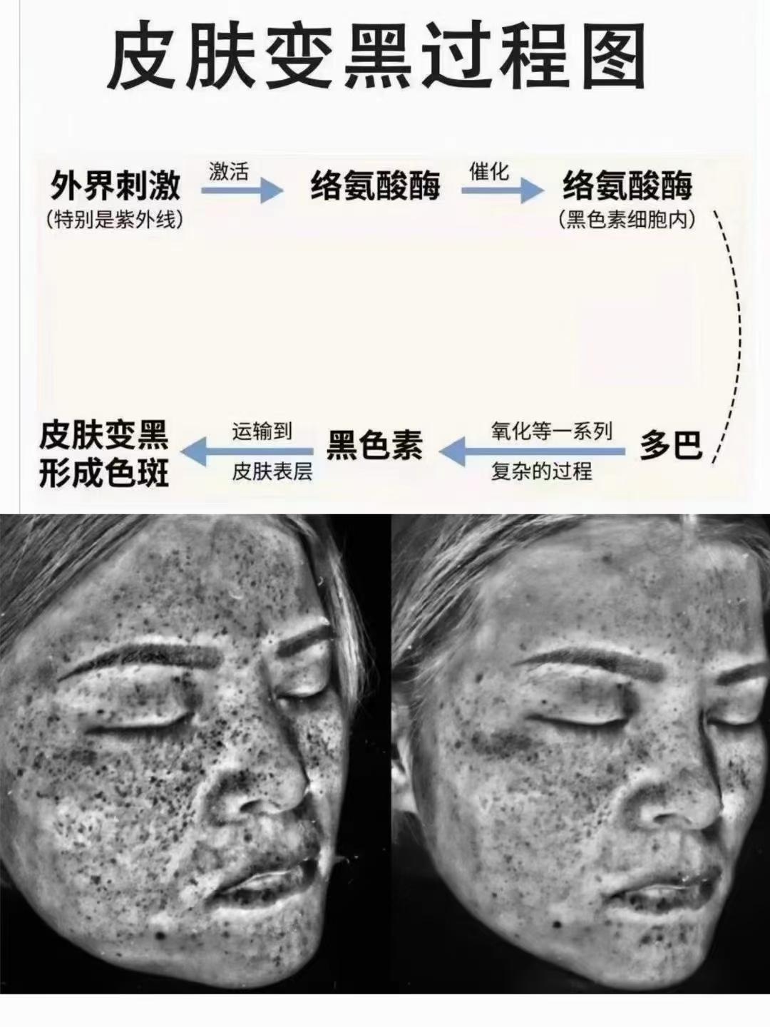 日光中的紫外线照射🌞是色斑形成的重要原因,这也是夏季更需要做