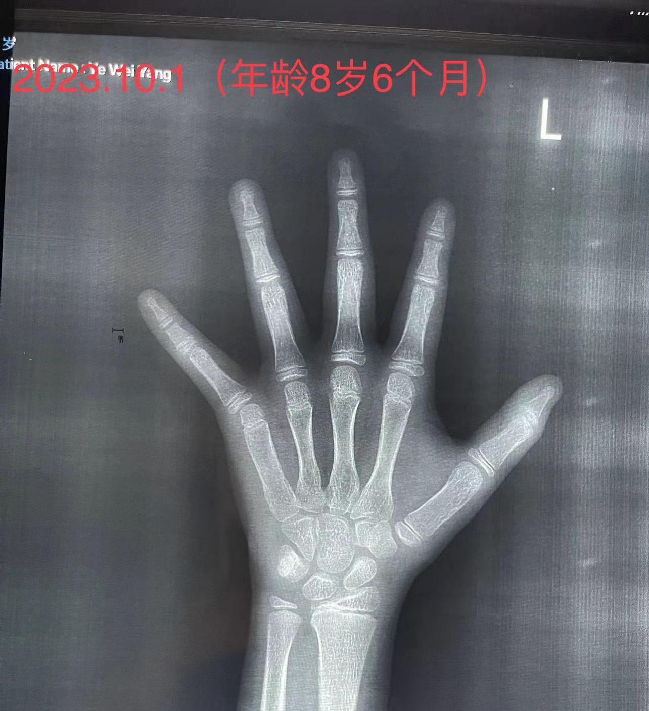 骨龄鉴定徐永剑 的想法 精准骨龄评测可以尽量避免过度医疗