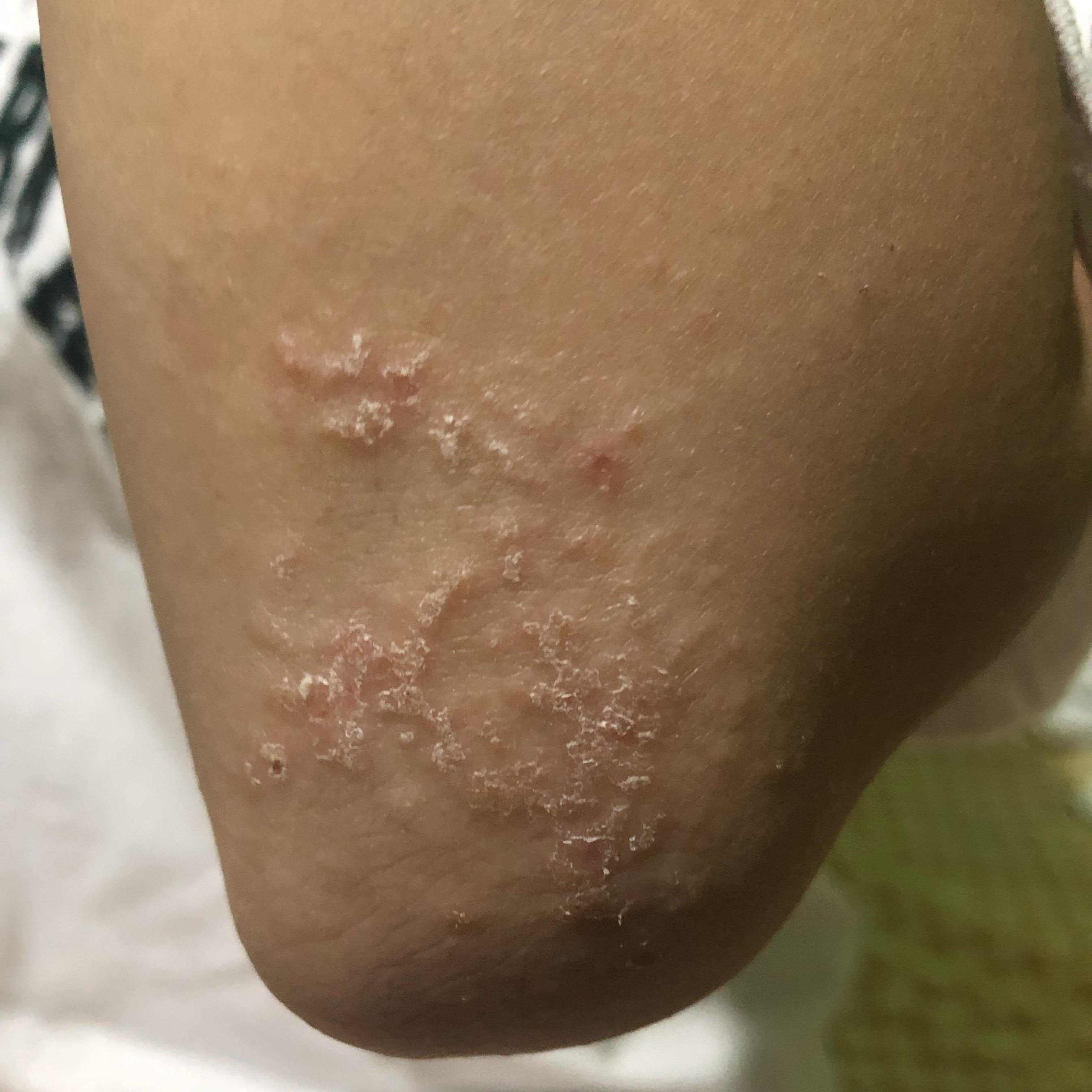 谁知道这个是什么皮炎.应该用什么药啊