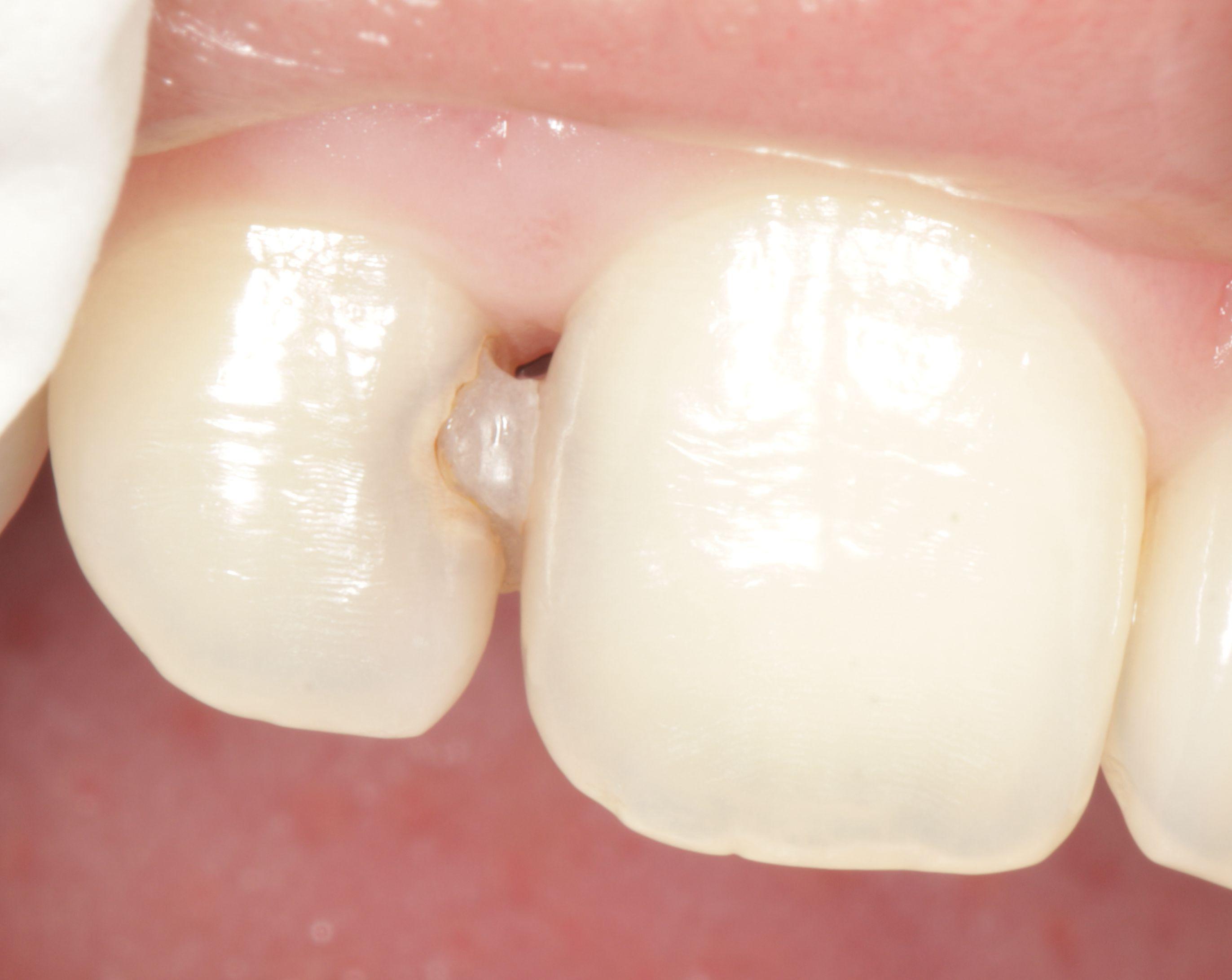 桃桃 的想法: 门牙龋齿补了2个😭😭 | 去年发现门牙旁边的尖牙一