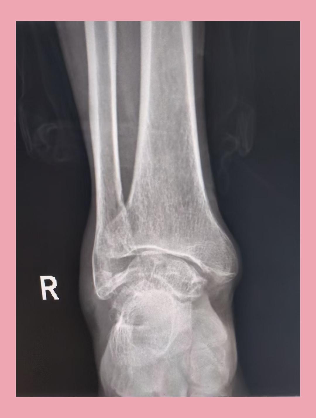 踝关节正侧位大骨节病影像描述