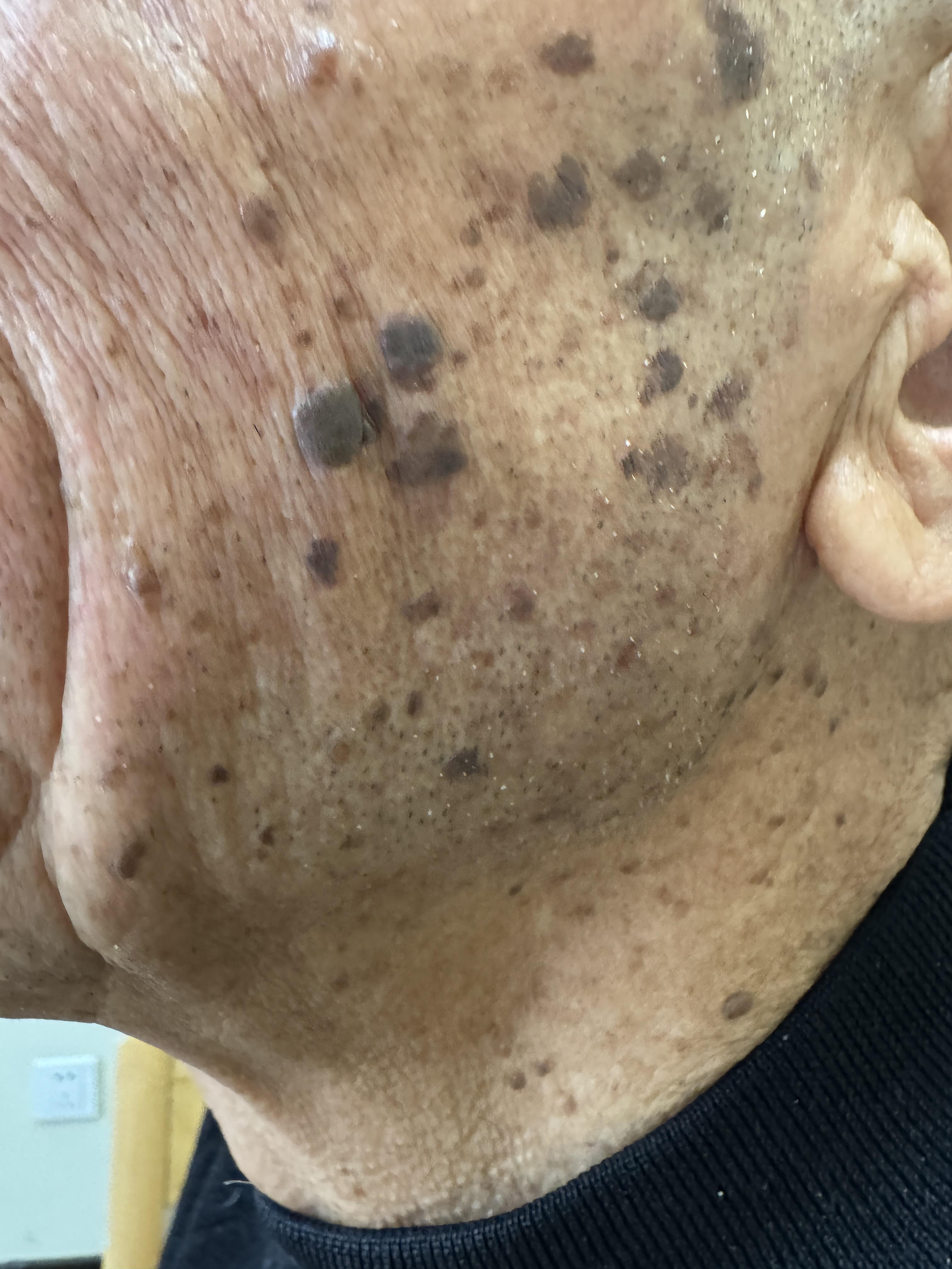 老年斑和老年疣是什么关系老年斑老年疣其实是一家子