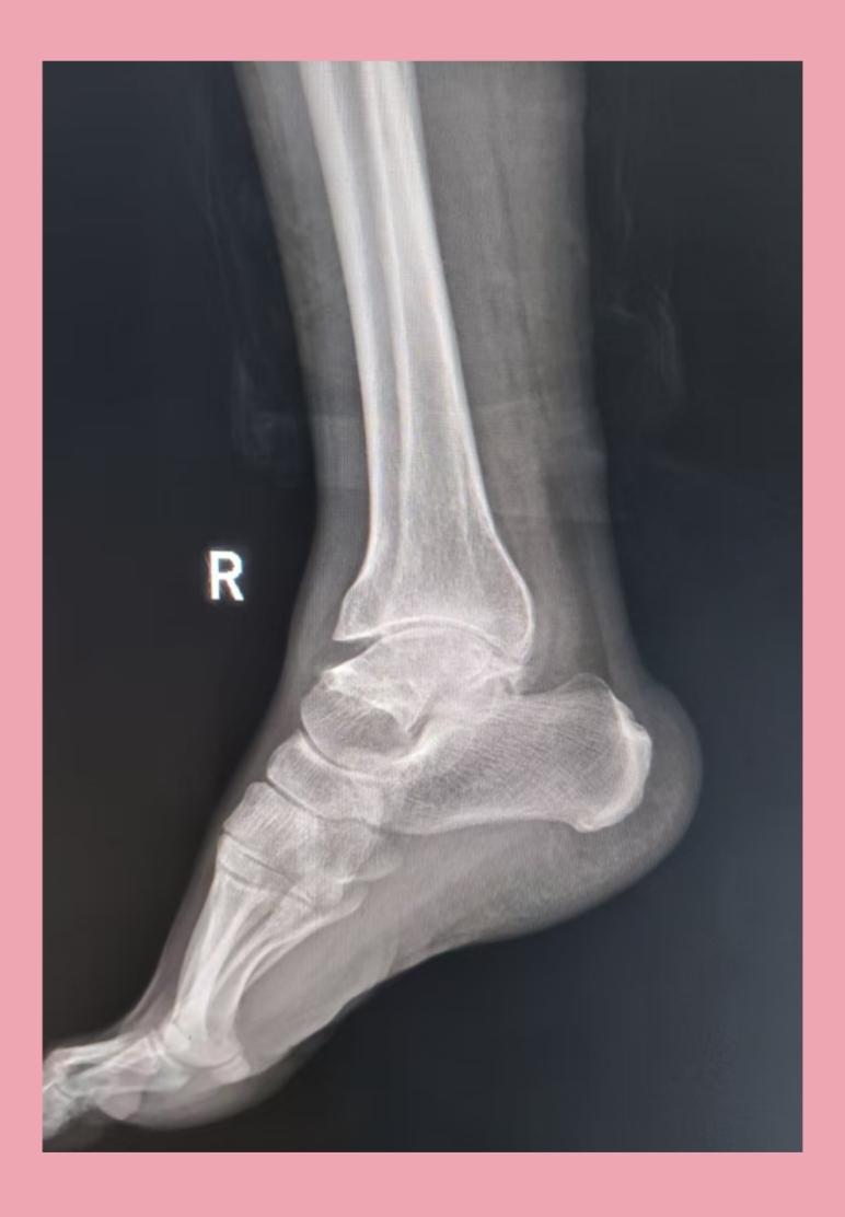 踝关节正侧位大骨节病影像描述