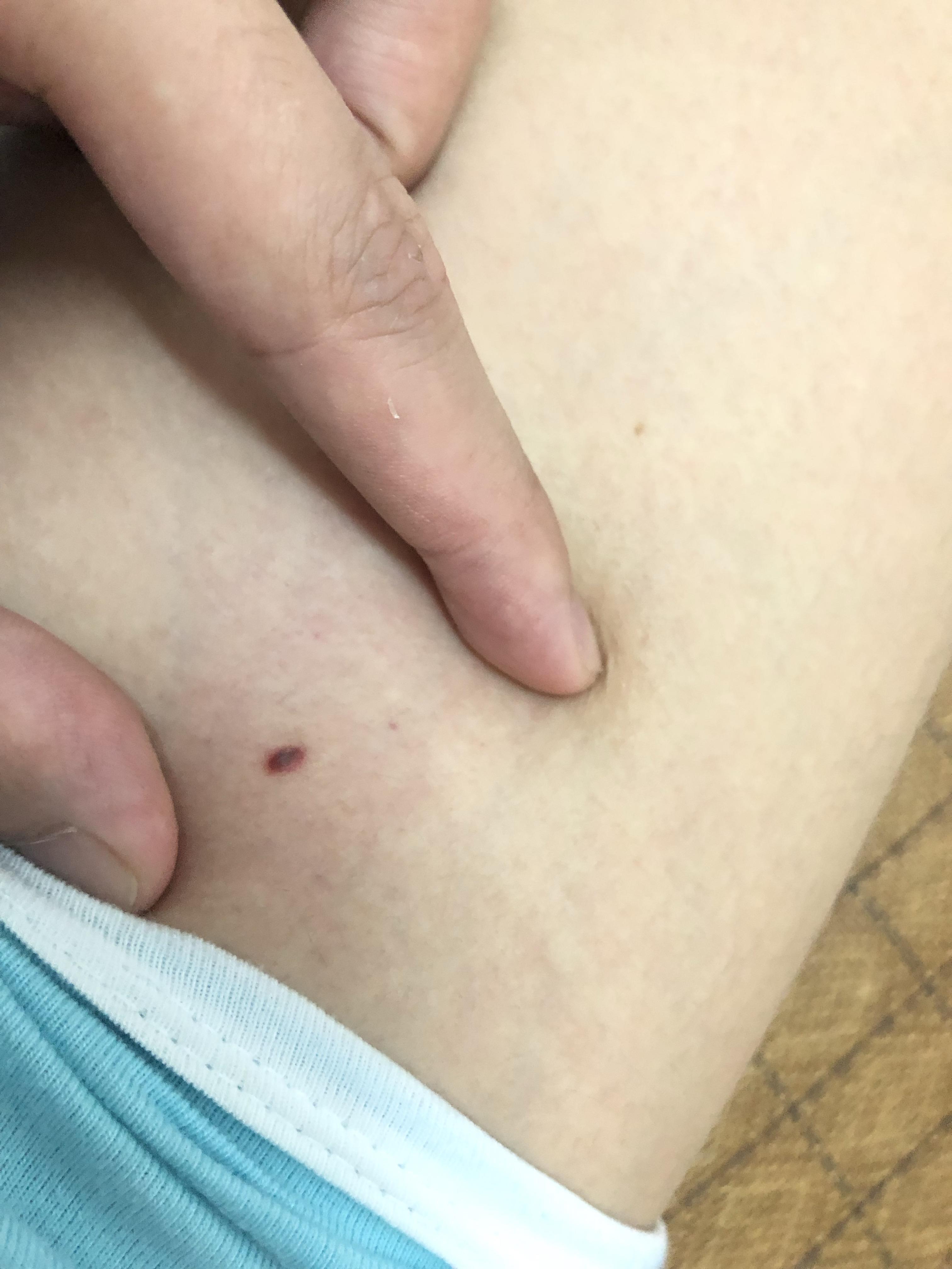 大腿内侧长红色的痣是怎么回事凸起来一点点