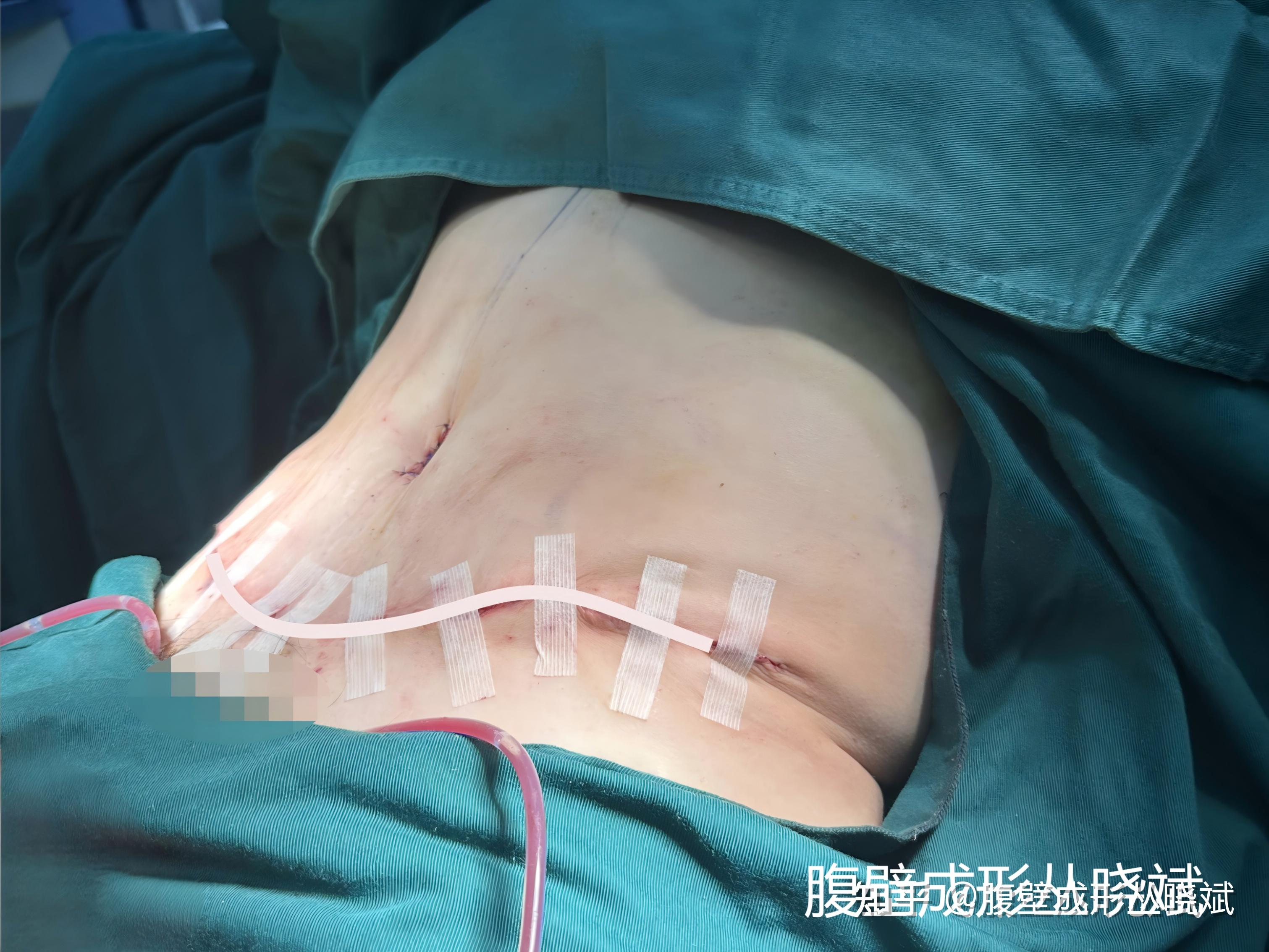 手术做完即刻就可以看到腰腹形态的改变,改善非常大,一眼就可以看出