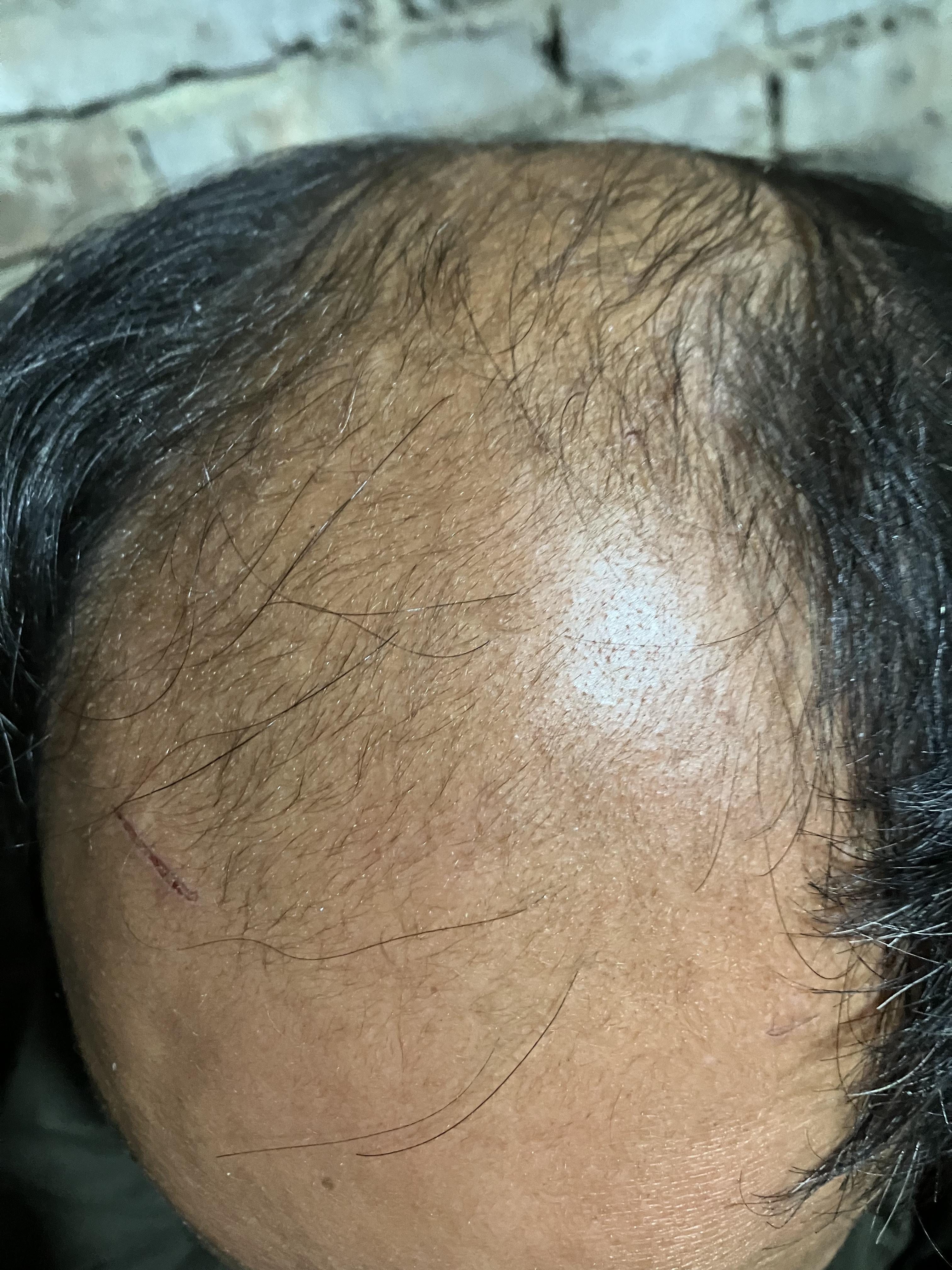 四有散人 的想法: 秃头的原因,到底是什么,为什么现