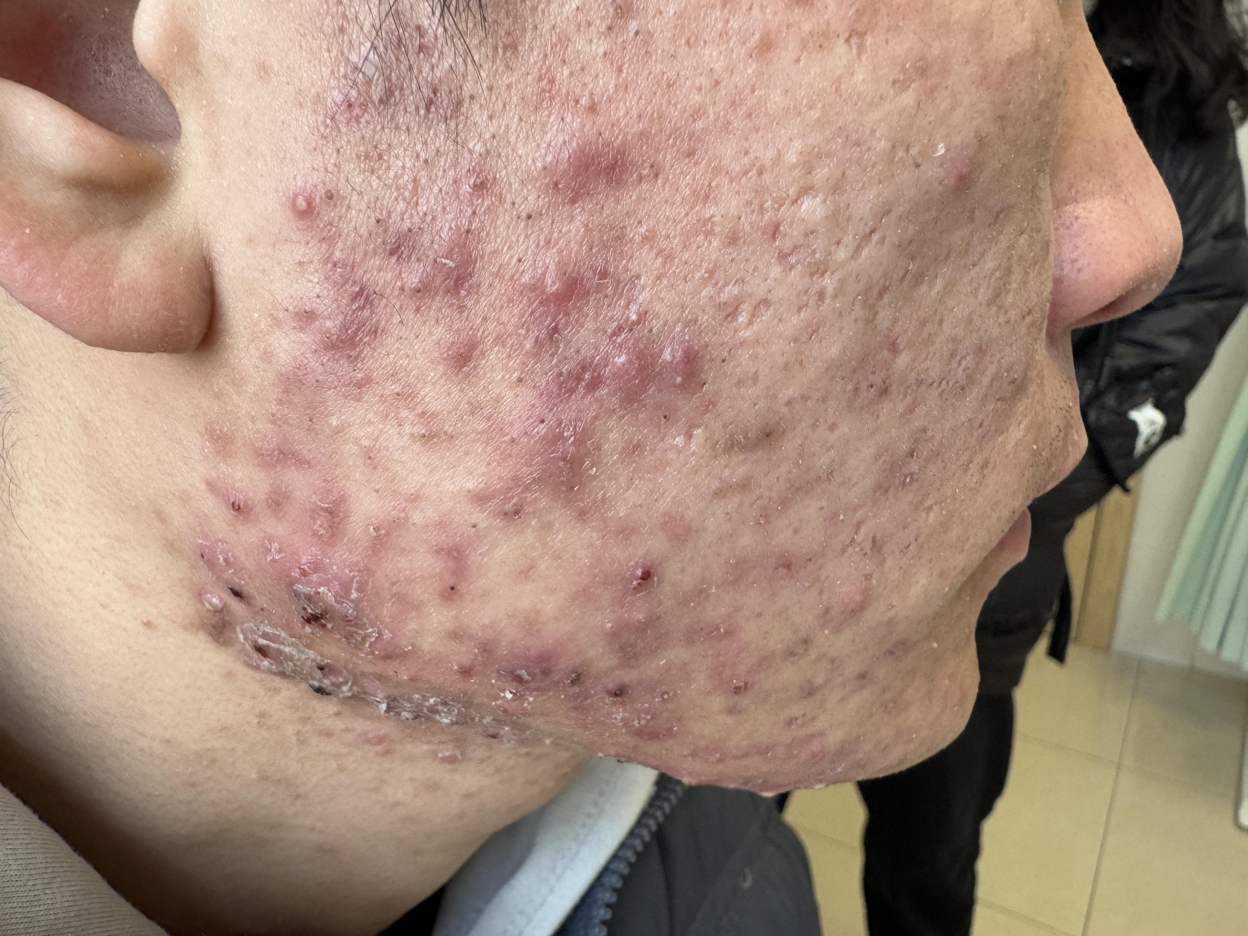 痤疮发炎了怎么治疗寻常痤疮就是一般所指的痘痘暗疮实在是太常见了