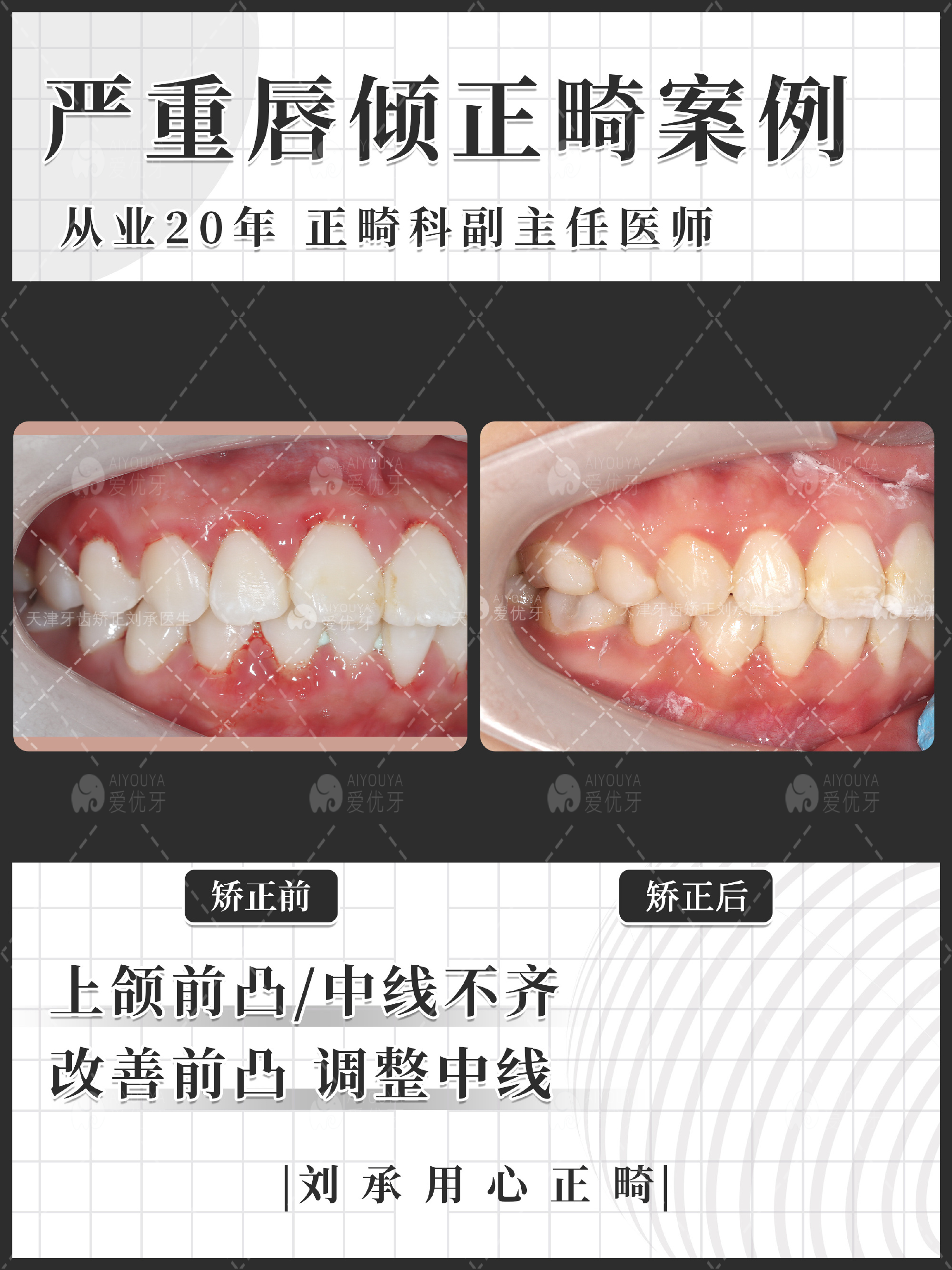 天津牙齿矫正刘承 的想法: 天津牙齿矫正|严重唇倾正畸案例分享