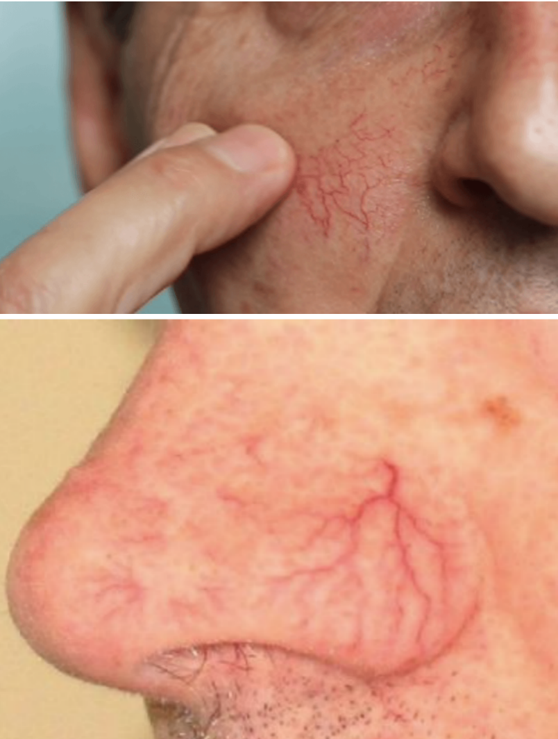 倩sur 的想法: 鼻子两边,面颊中间出现"红血丝",一进空调房或者是吃