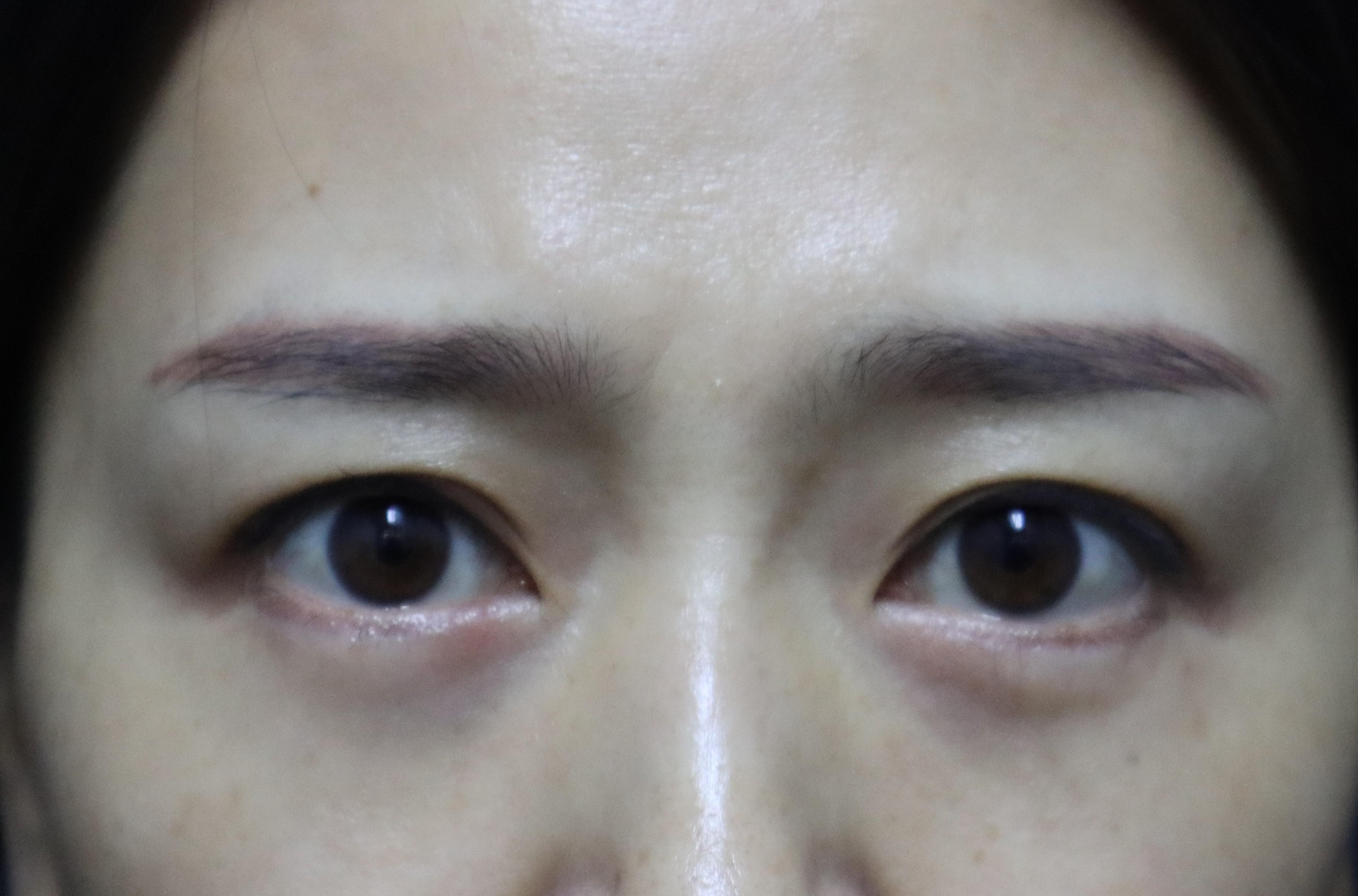 整形医生郑永生 的想法: 【下睑修复案例分享】这位女性来自祖国