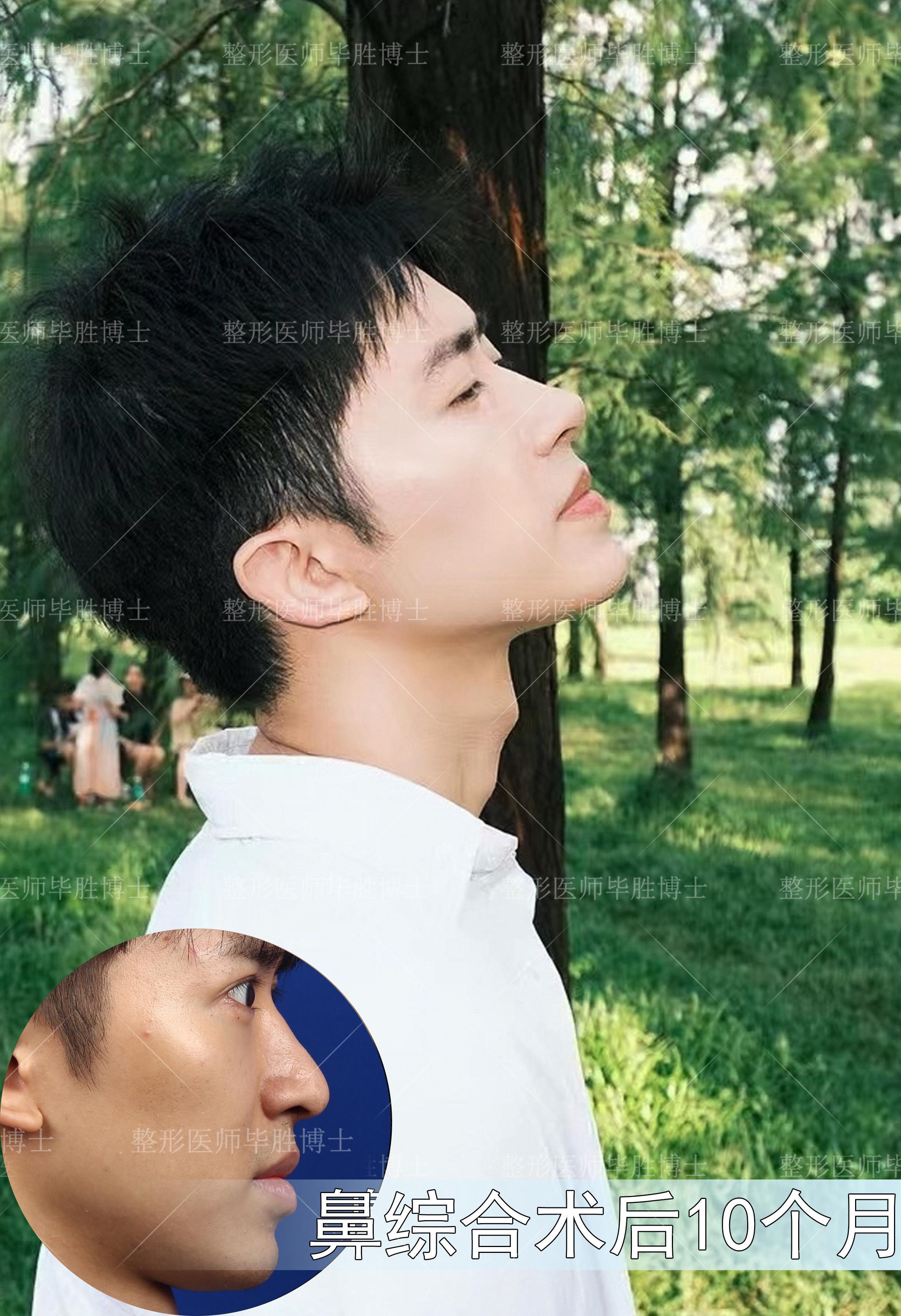  br>曾经有朋友问毕胜教授是不是因为擅长做鼻子才改形"毕(鼻)"~ a