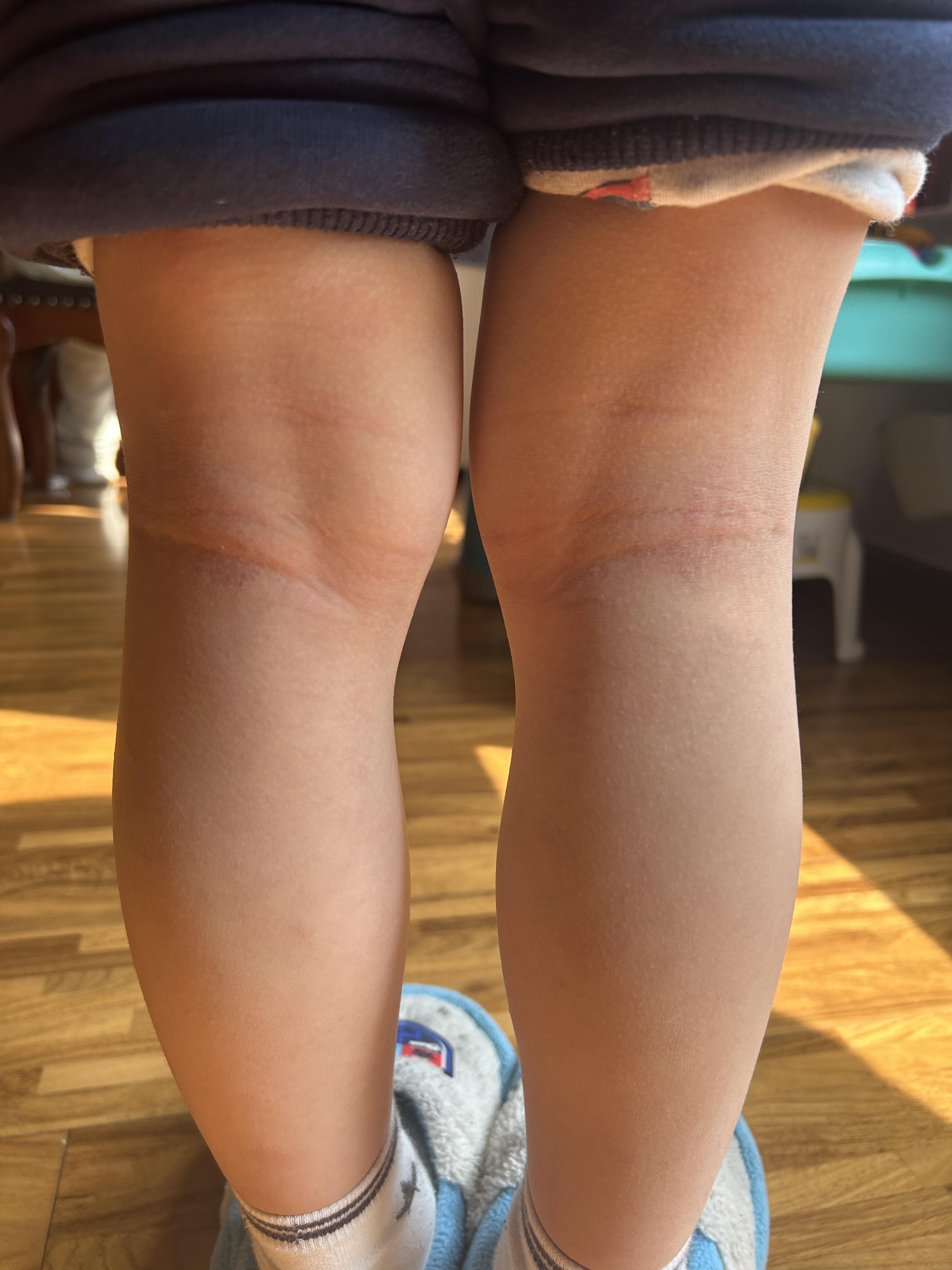 护肤在西塘 的想法: 曲侧湿疹,儿童特应性皮炎的典型表现!