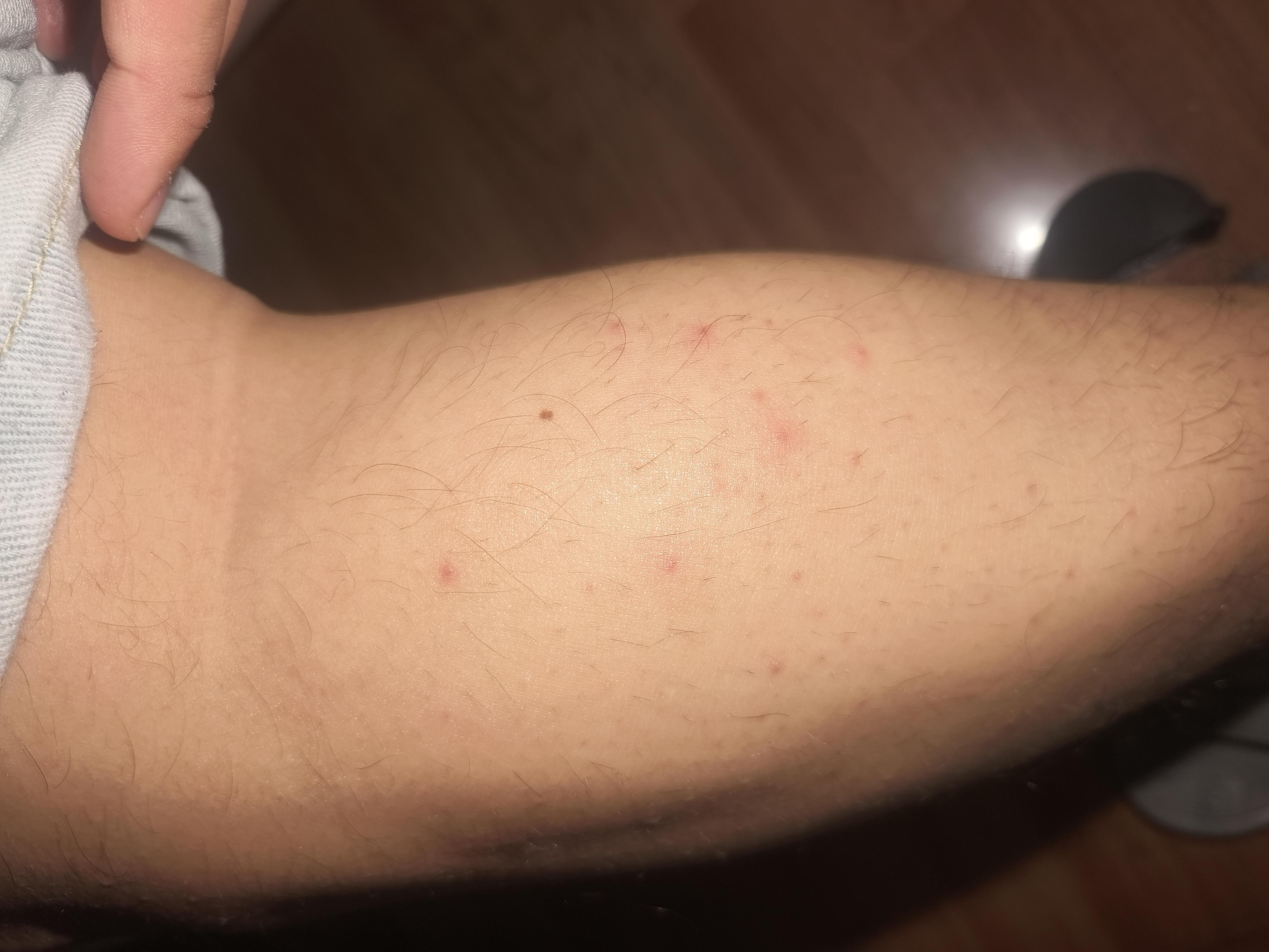 dream 的想法: hiv急性期皮疹