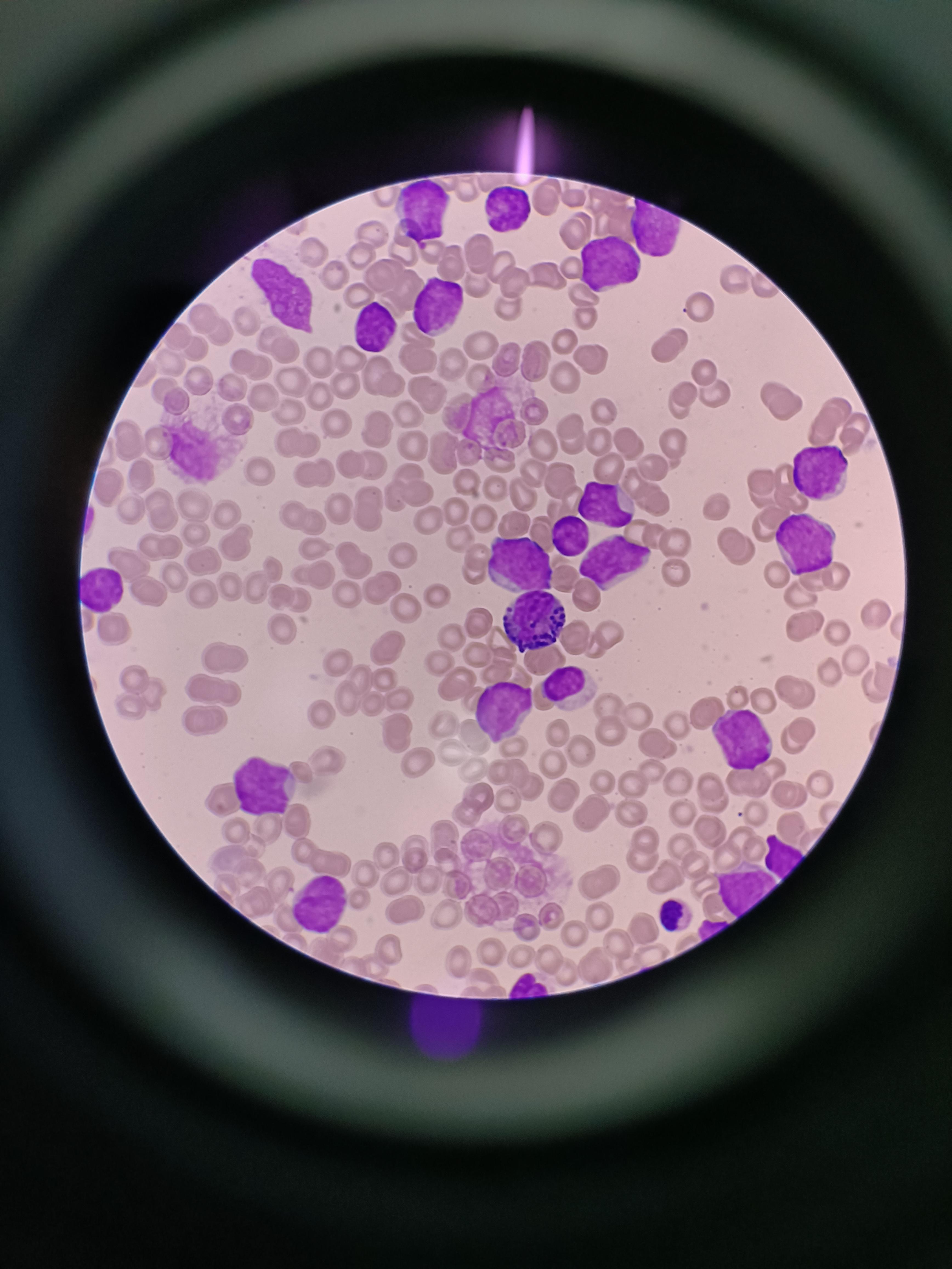 白细胞计数:236×10的9次方每升