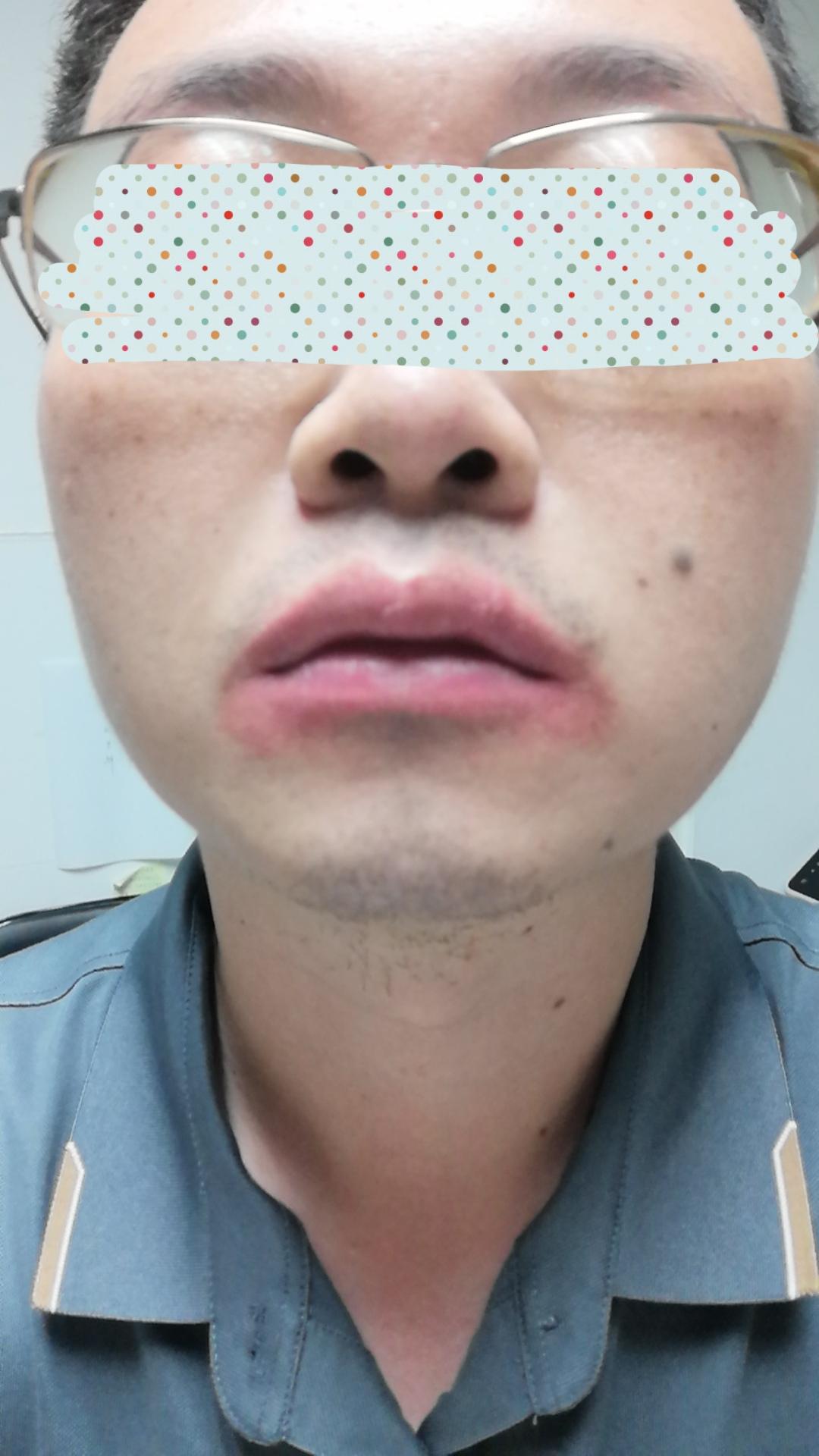 闪亮的狗狗 的想法: 口周炎唇炎治疗心得体会 | 第一次正式发文希望能