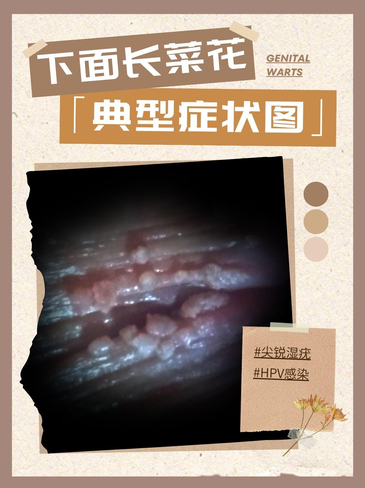 南京优嘉病毒疣医学研究所 的想法: 尖锐湿疣症状图片