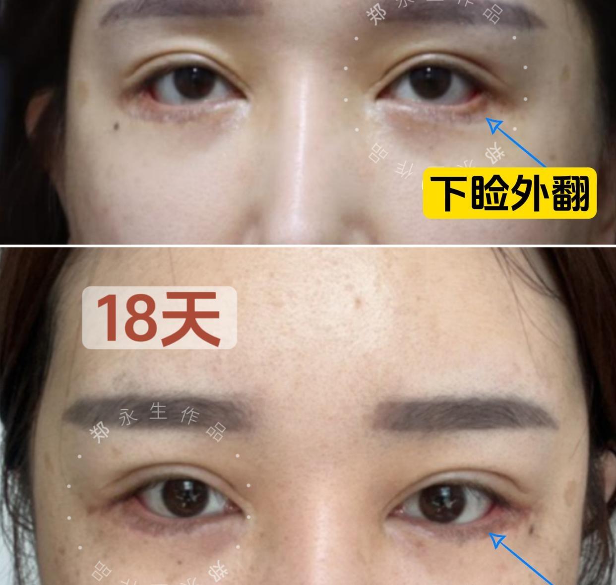 整形医生郑永生 的想法: 下睑外翻矫正后护理指南,做好了事半功倍!