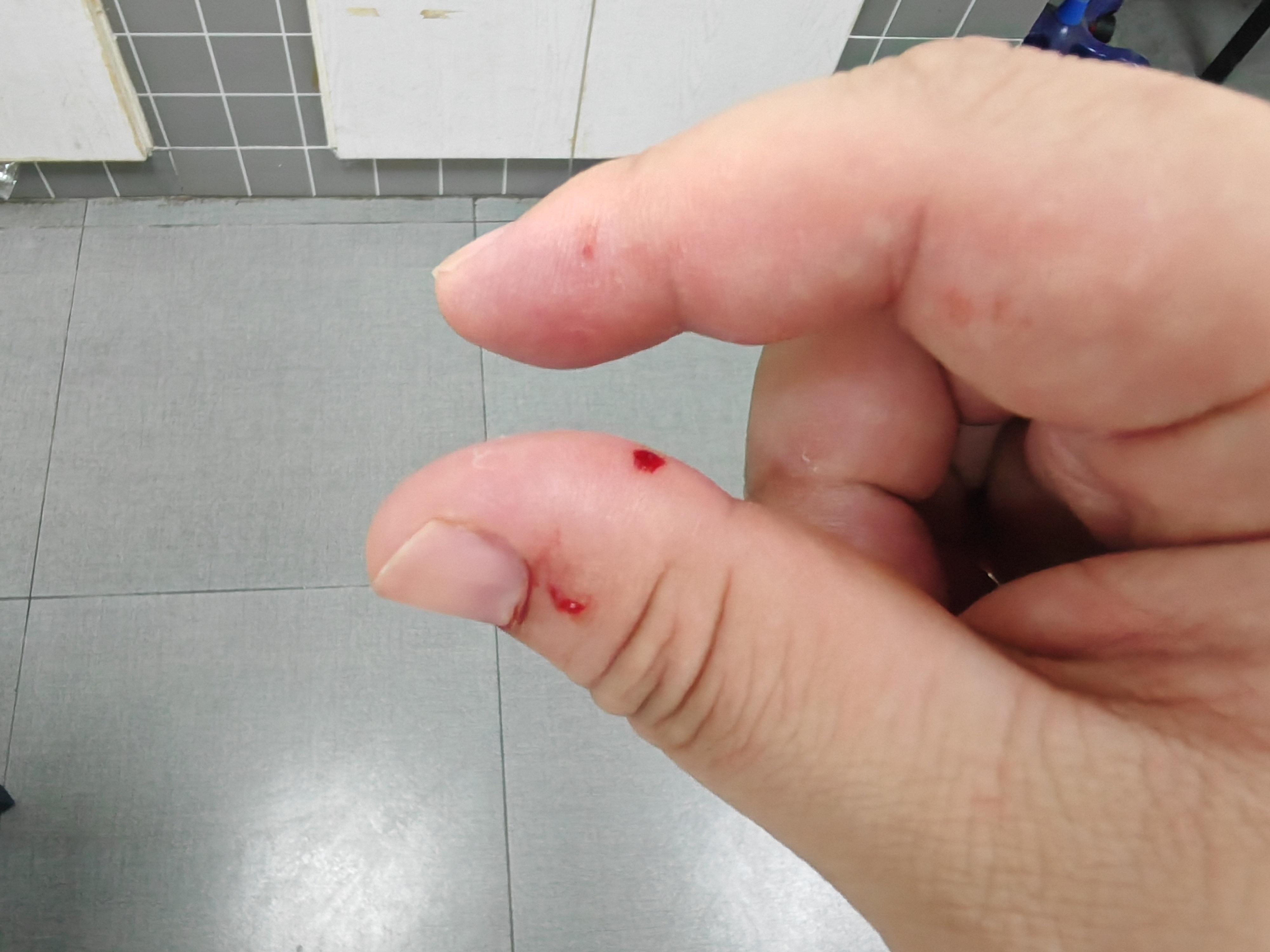 狂犬疫苗年年打 | 每年都要不定期被咬好几次,身上不开几个洞缝几针