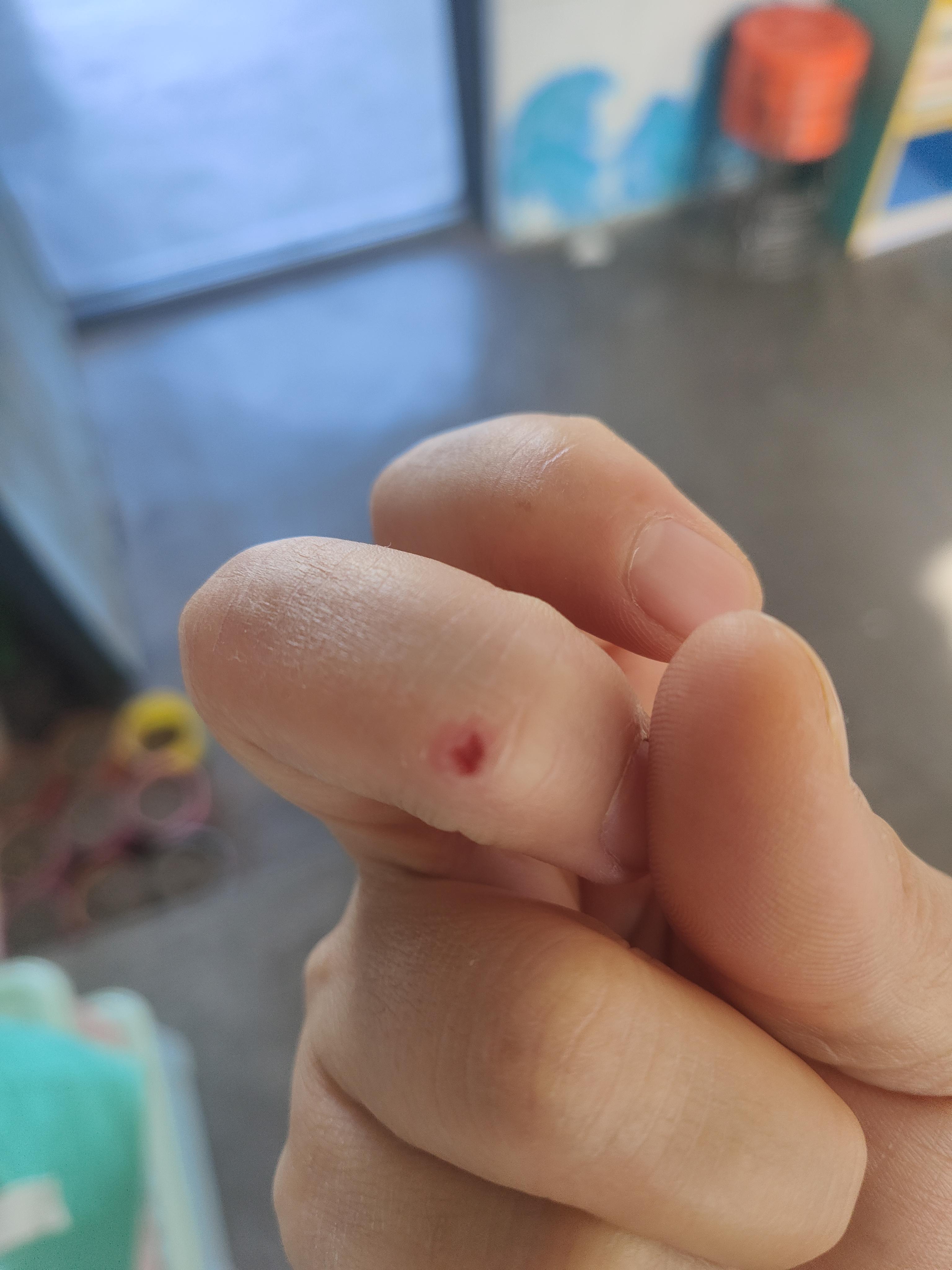 如烟 的想法: 记录治好手上疣子的过程