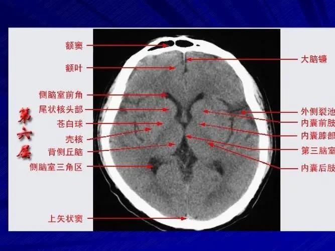青虫 的想法: 2核医学中级考试每日一题(考点回忆) | 断层解剖-外侧裂、丘脑 #影像医学与核医学 #核医学 #中级医师 - 知乎