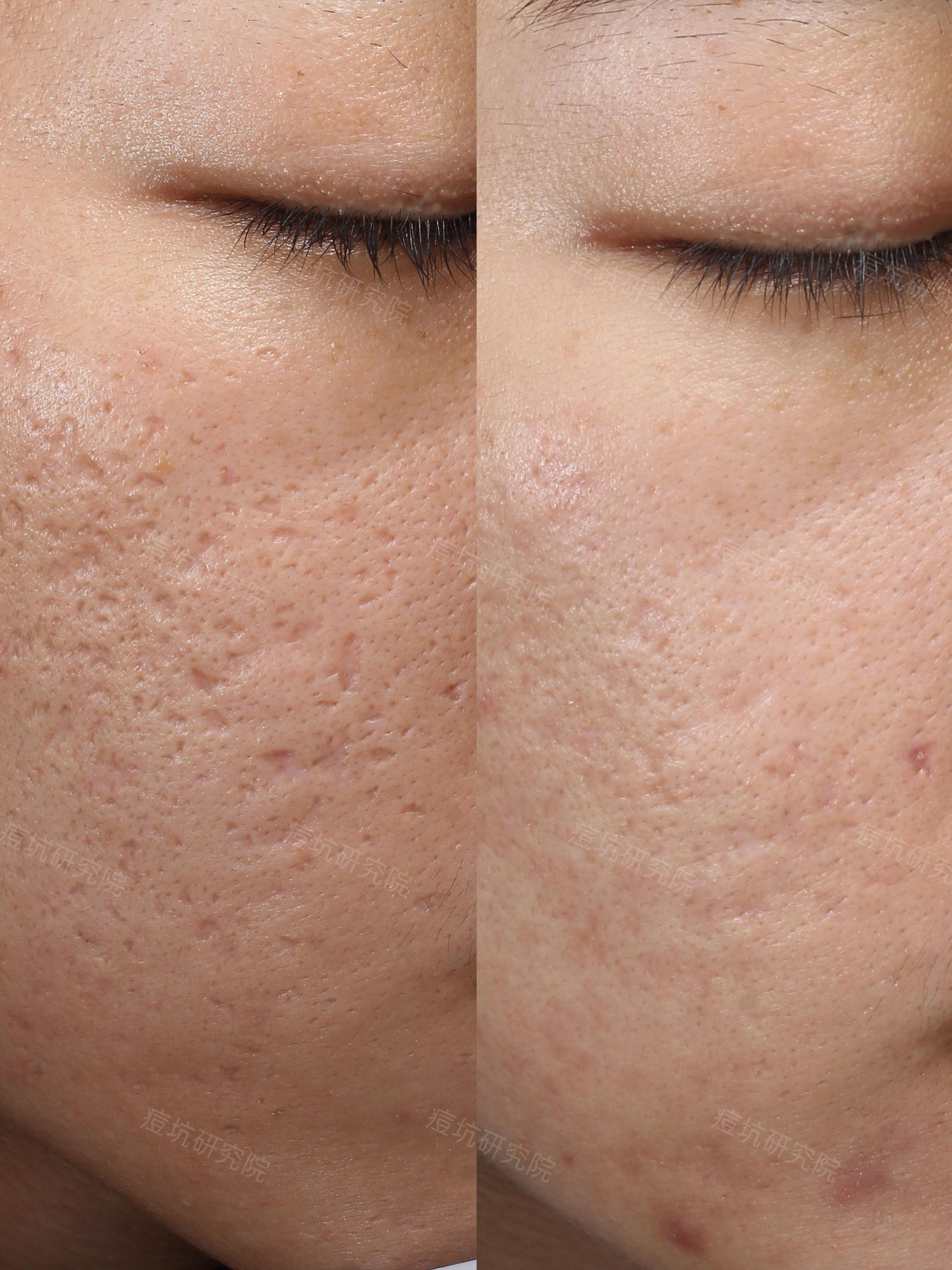 颜植痘坑研究院 的想法: 更新一组高清近距离痘坑修复前后对比图