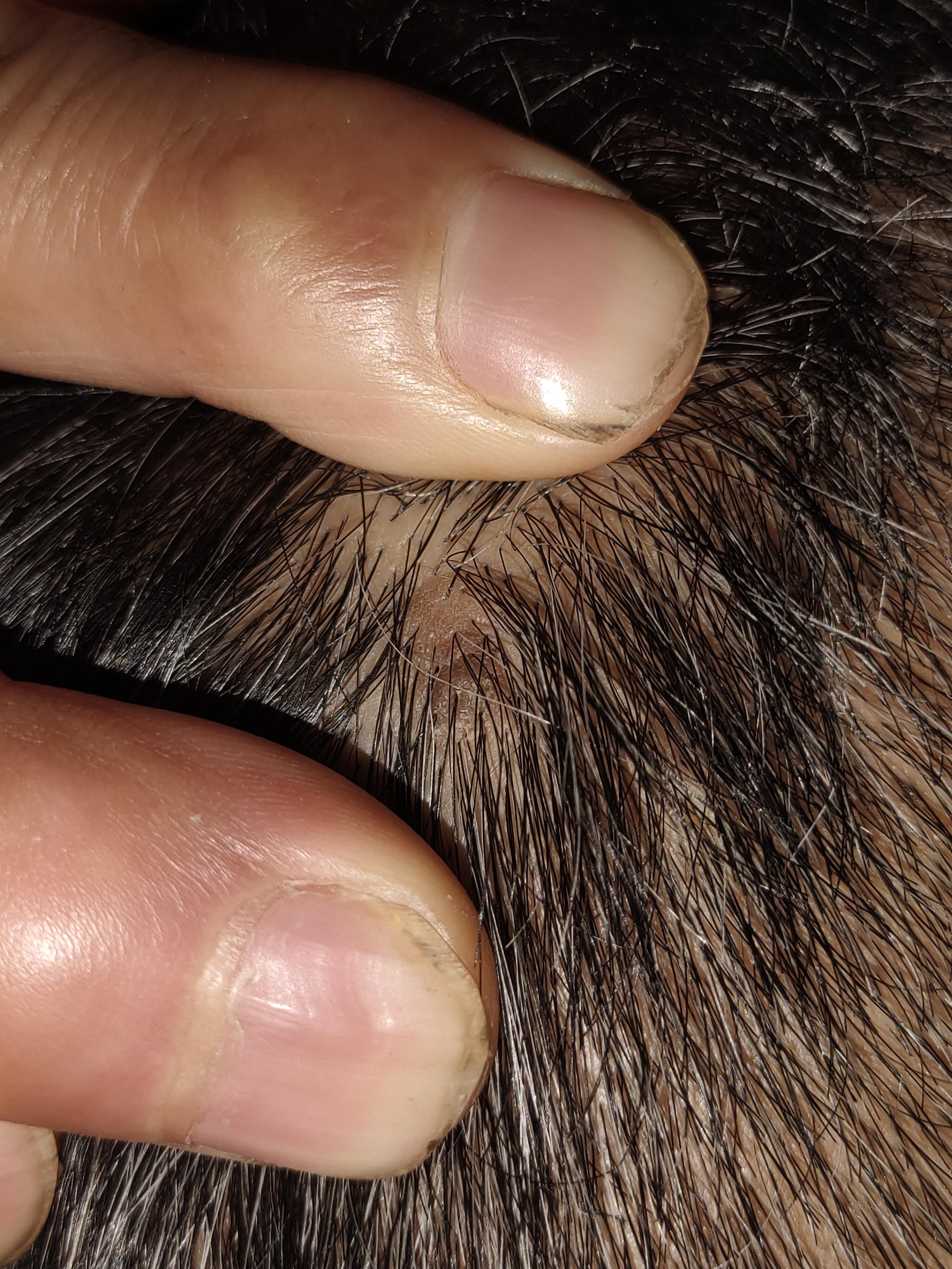 小火苗 的想法: 请问头上长这种像结痂一样的疙瘩是咋回事啊