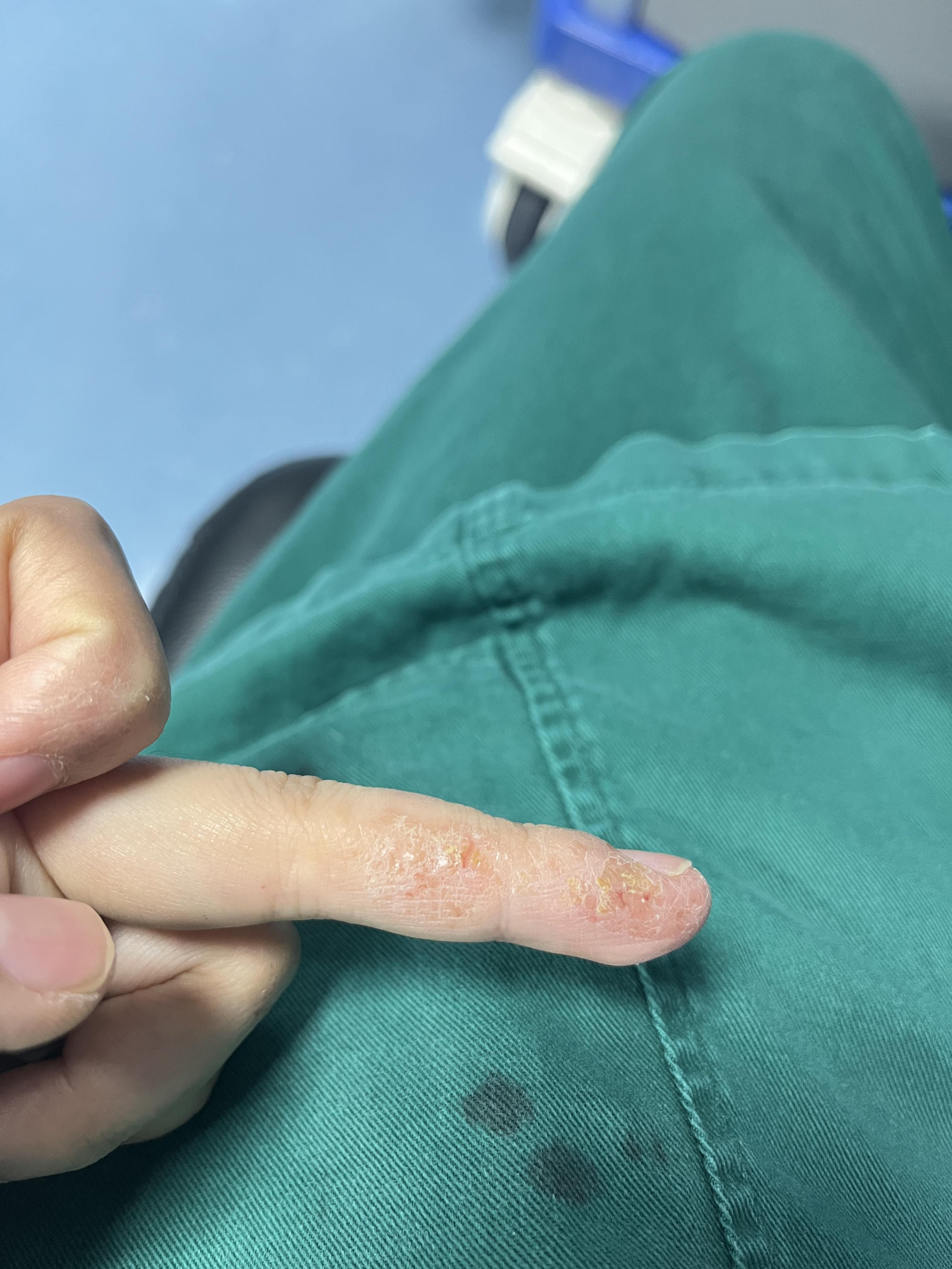 的想法: 困扰我一年的湿疹症状渐渐好转