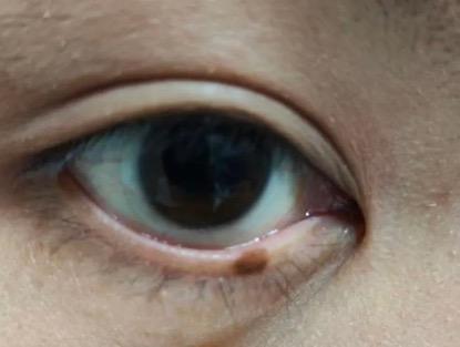 李薇薇 的想法: 睑缘缘长了一颗痣,该怎么办?