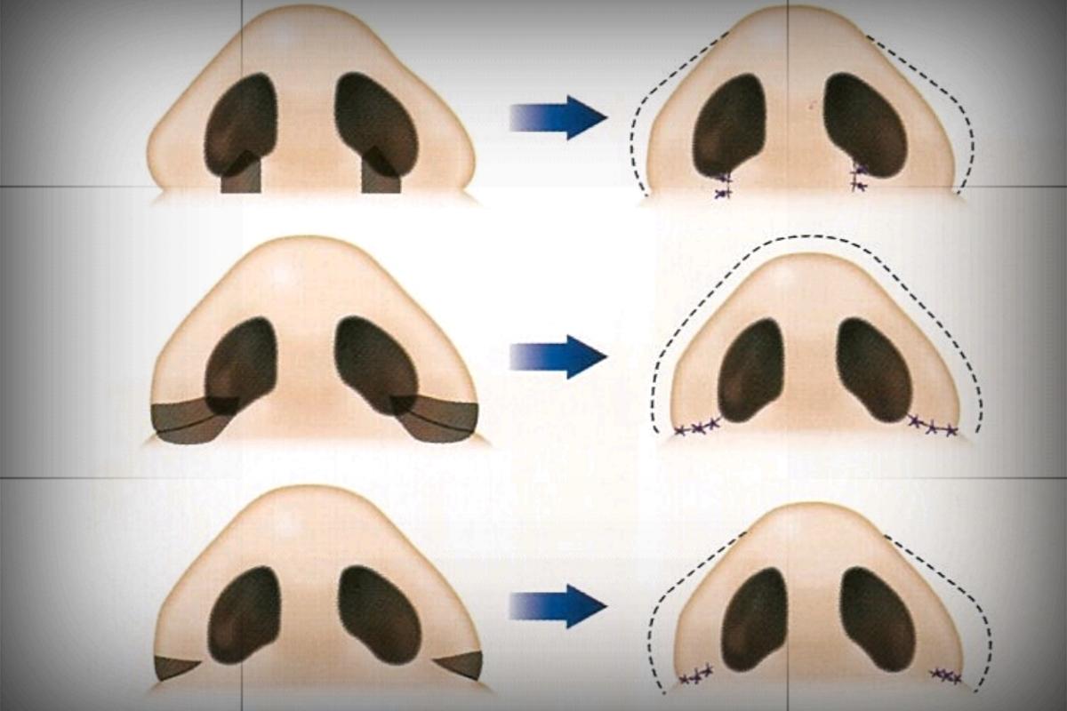 鼻大叔杜亚旭医生 的想法: 鼻翼缩小:内切和外切的区别