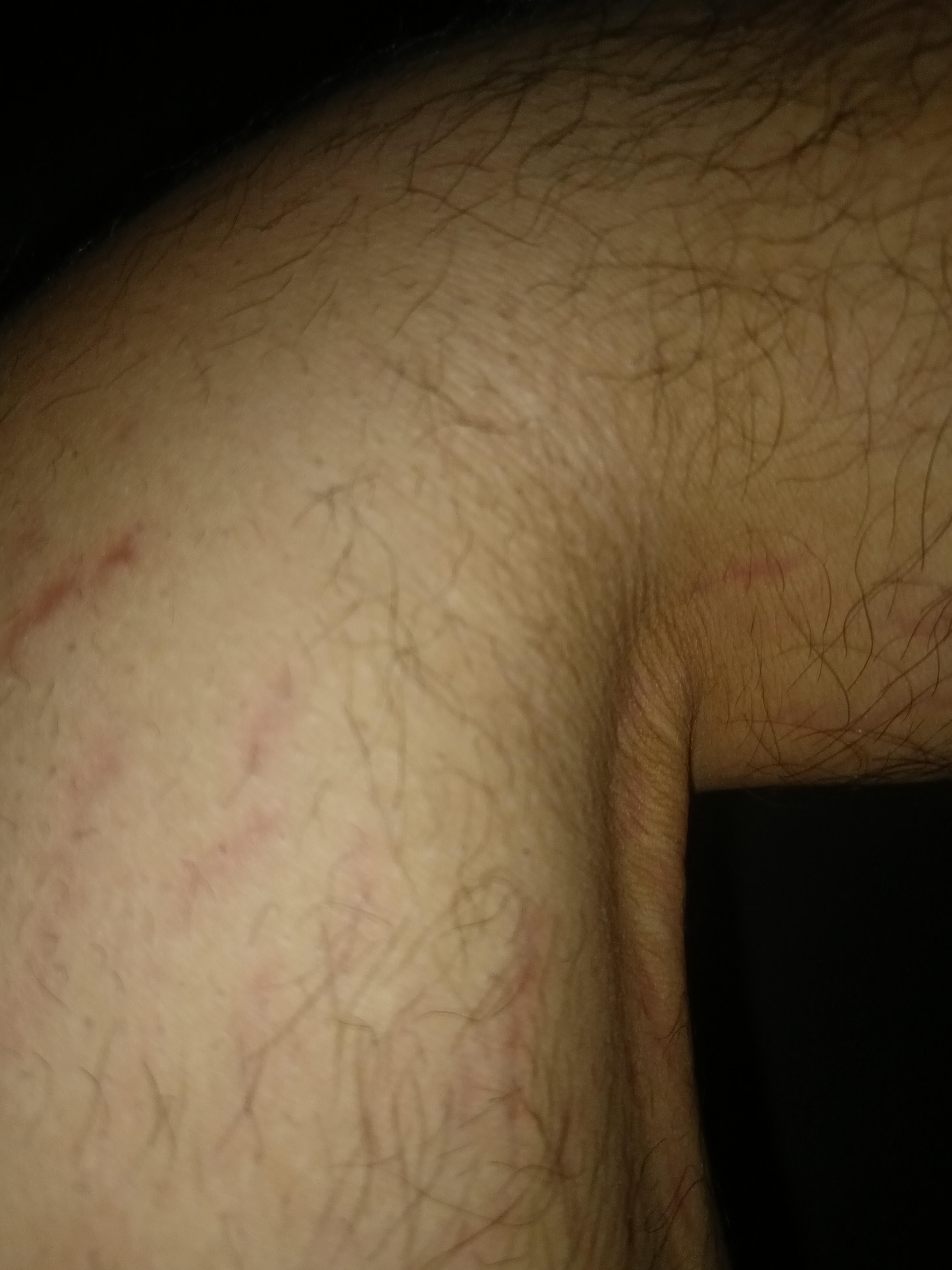 九阳 的想法: 胳膊大腿上出来的这个纹是什么东西有人知道吗 - 知乎