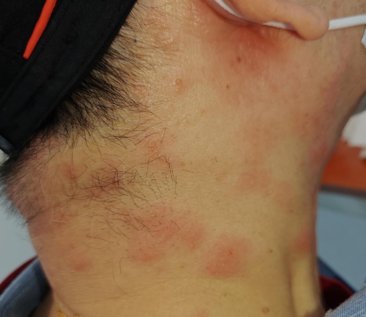 缠腰蛇要想好的快,就要听西医医生的话,就是在发病的最早期,能够吃