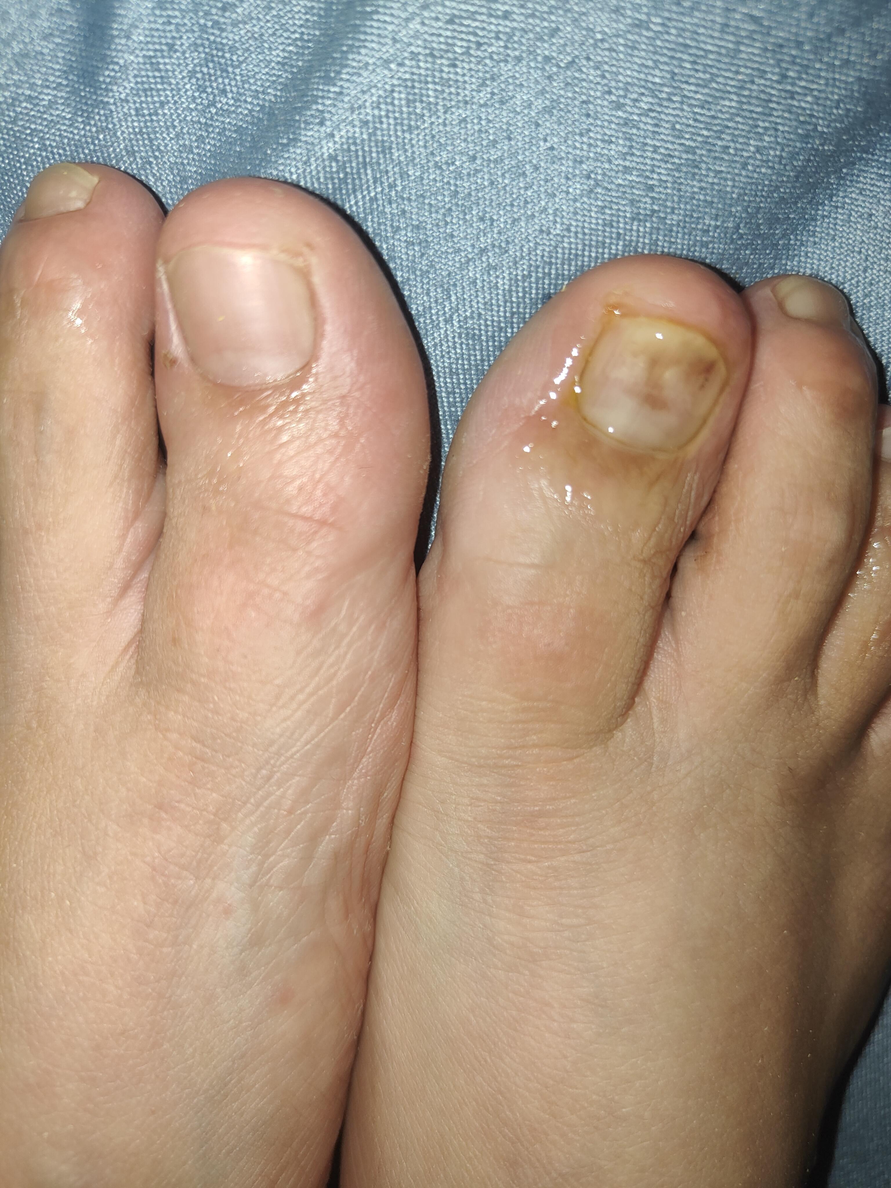 昵称 的想法: 记录自用方式治疗灰指甲