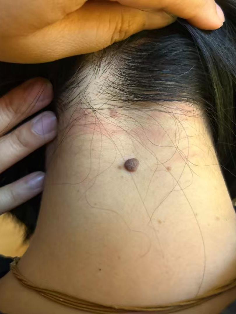 婚恋情感咨询师 的想法: 千里寻觅巧遇后脖颈有颗同样的苦情痣