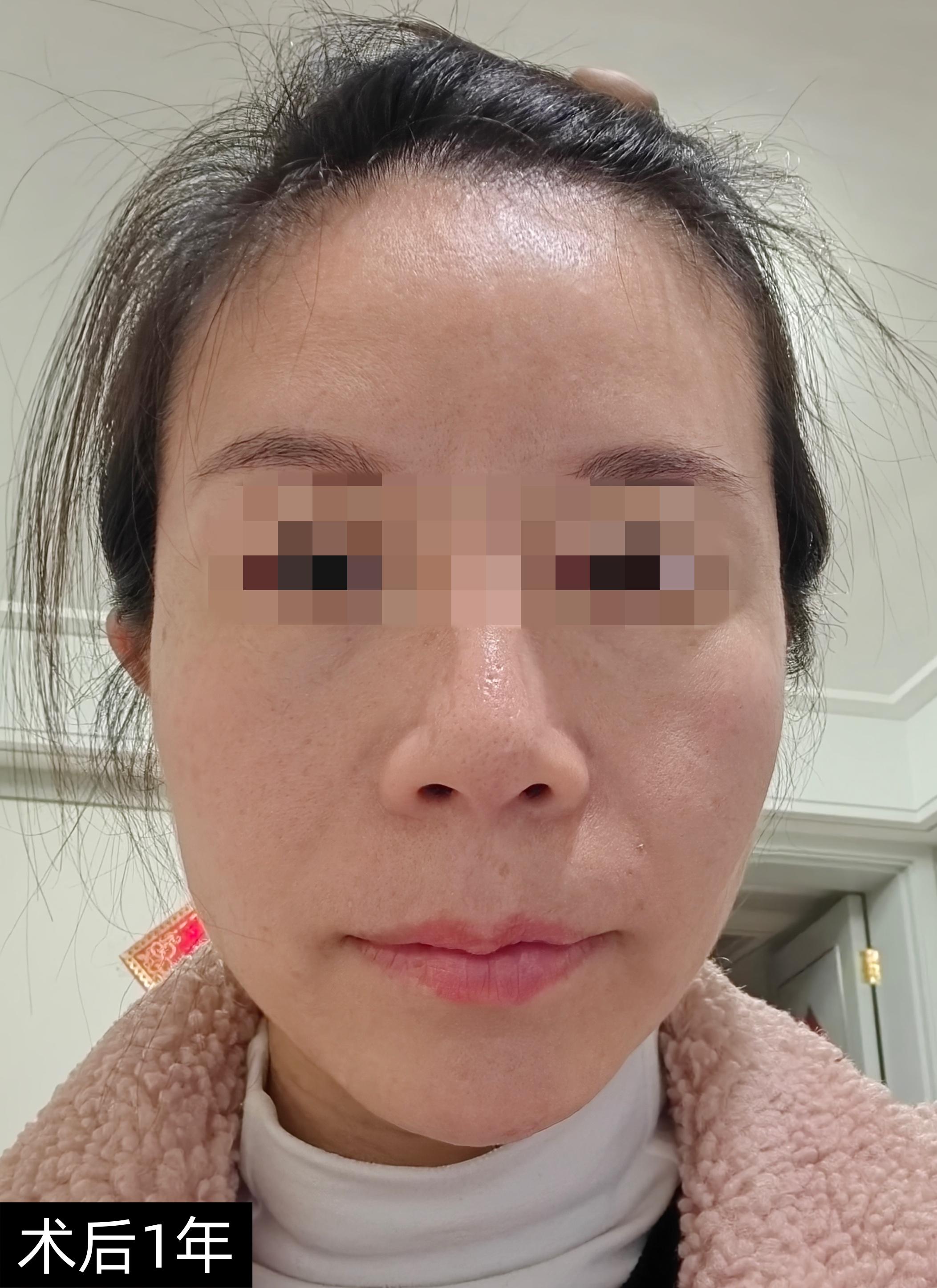 整形医生路会 的想法: 太阳穴一旦凹陷,脸部整体轮廓就会变得凹凸不平