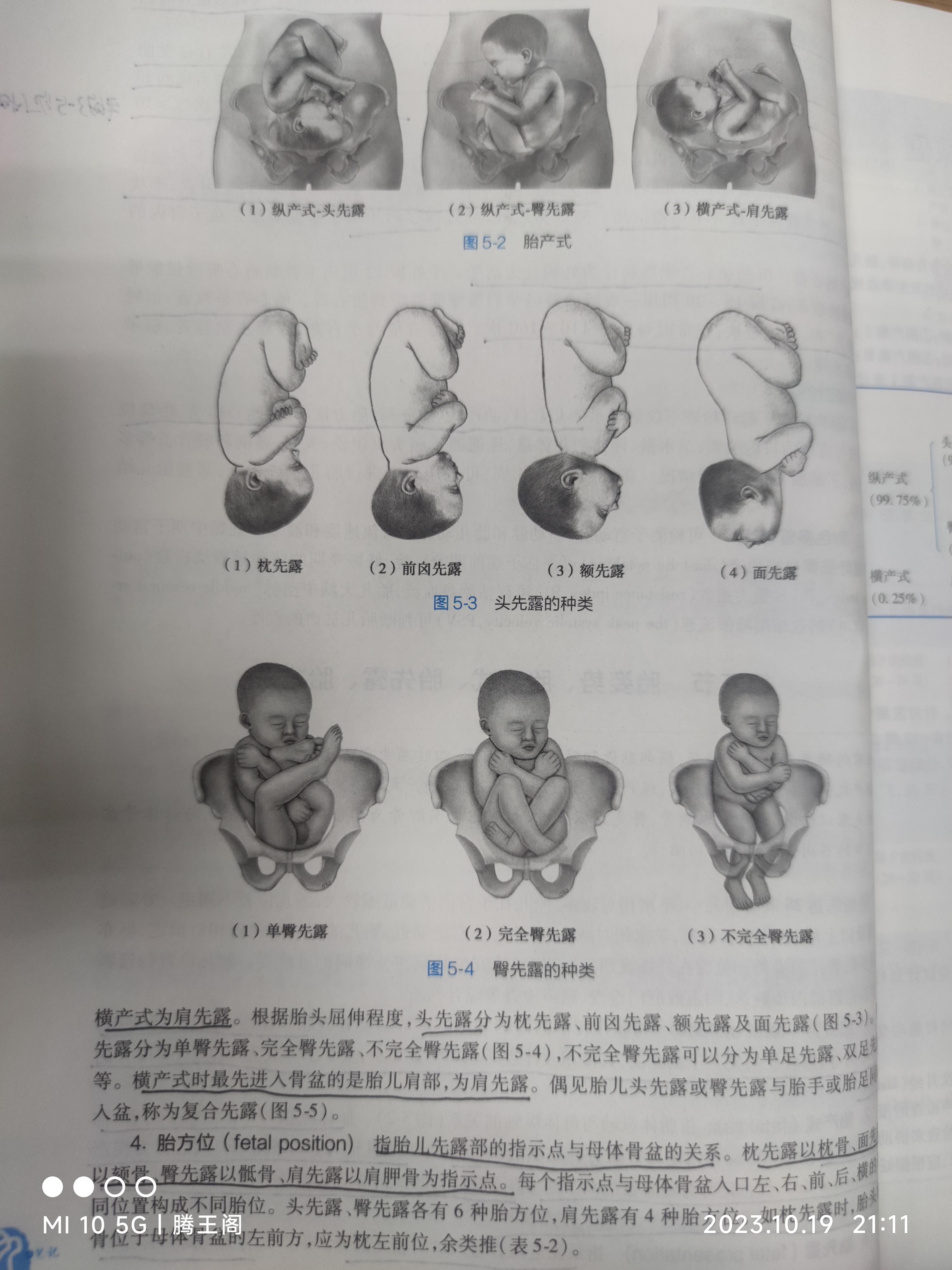 胎方位lop是什么意思图片