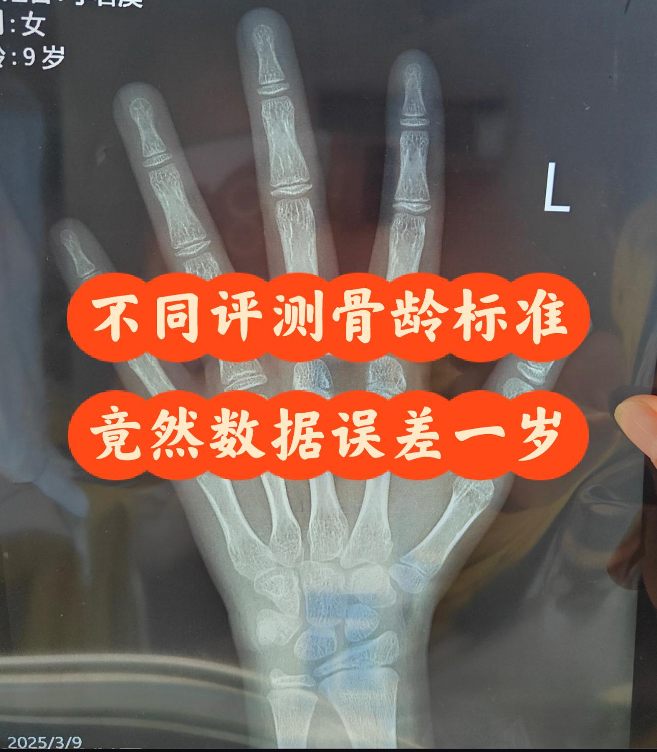 不同评测骨龄标准竟然数据误差一岁案例分析20151111女38公斤净身高