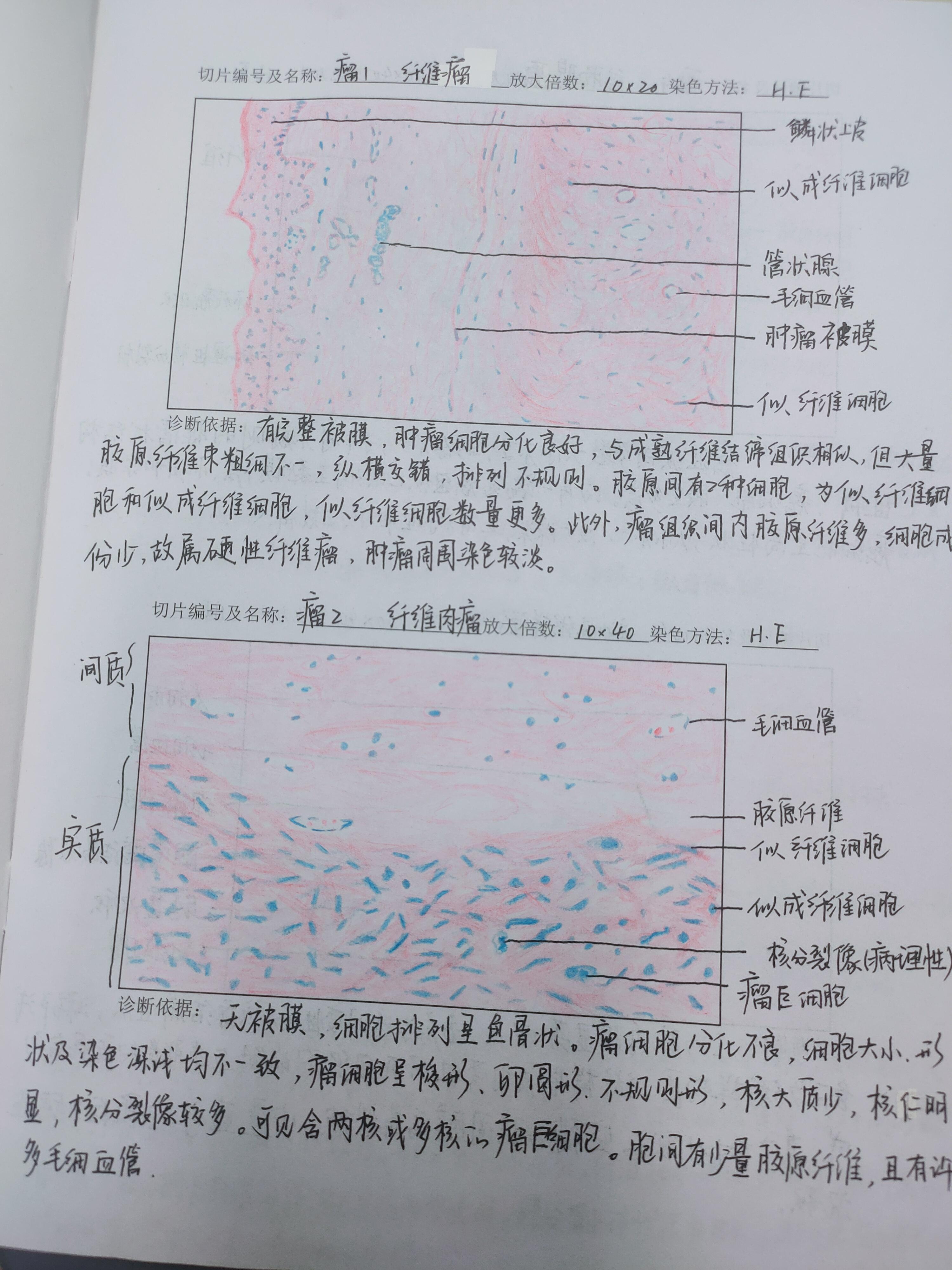 的想法: 病理学红蓝铅笔绘图 br>1皮肤鳞癌 br>2乳头状瘤 br>3纤维瘤 