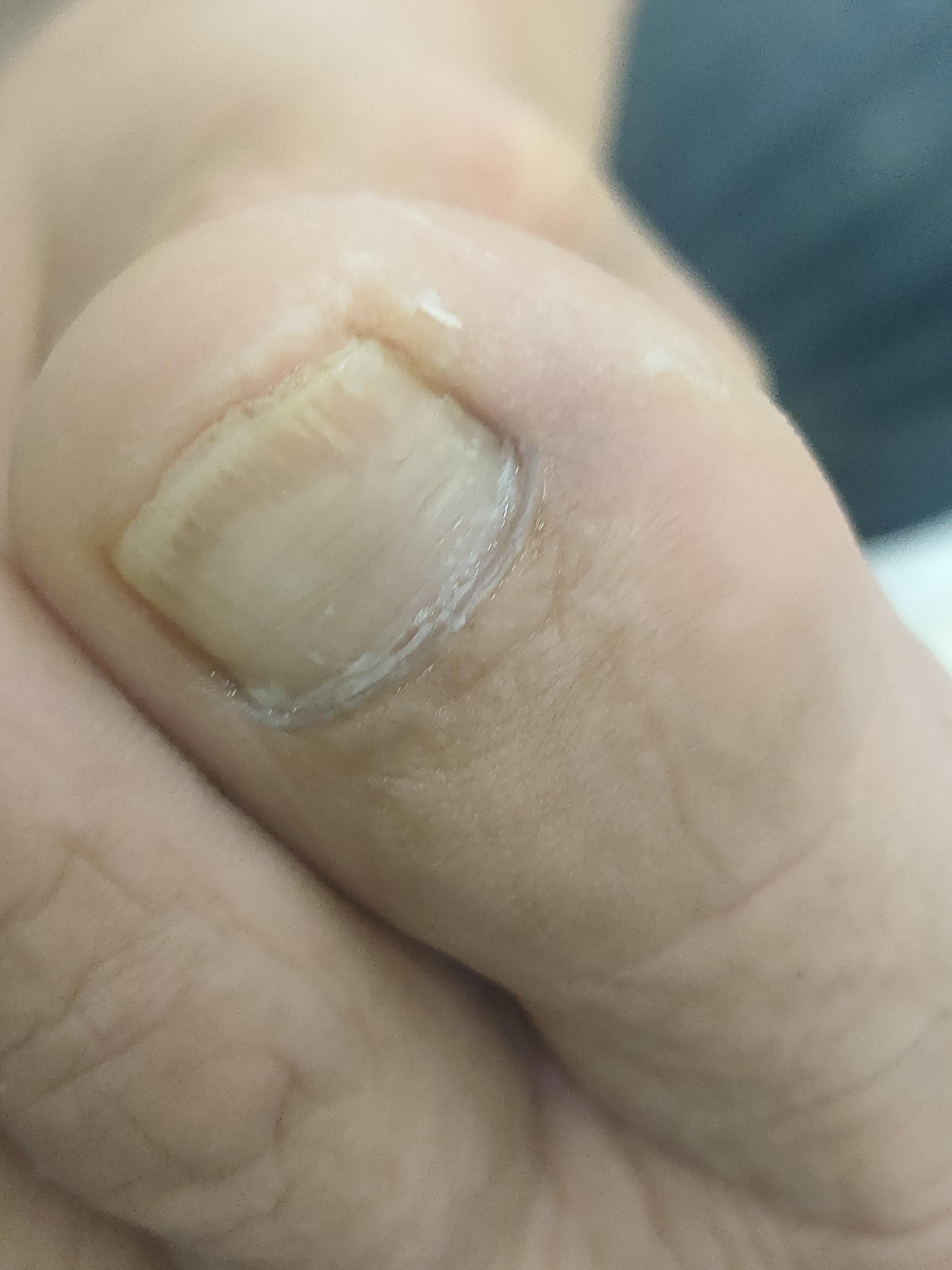 小飞 的想法: 灰指甲