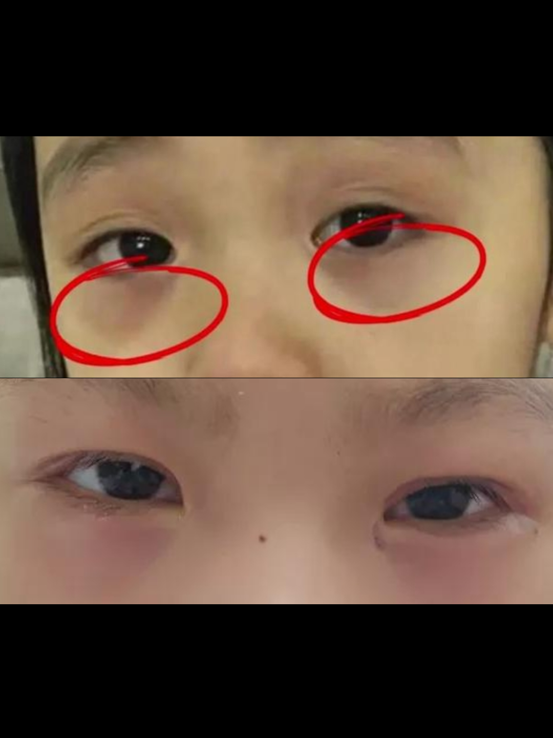 中医儿科李建医生 的想法: 孩子下眼袋发青,这其实是身体发出的一个