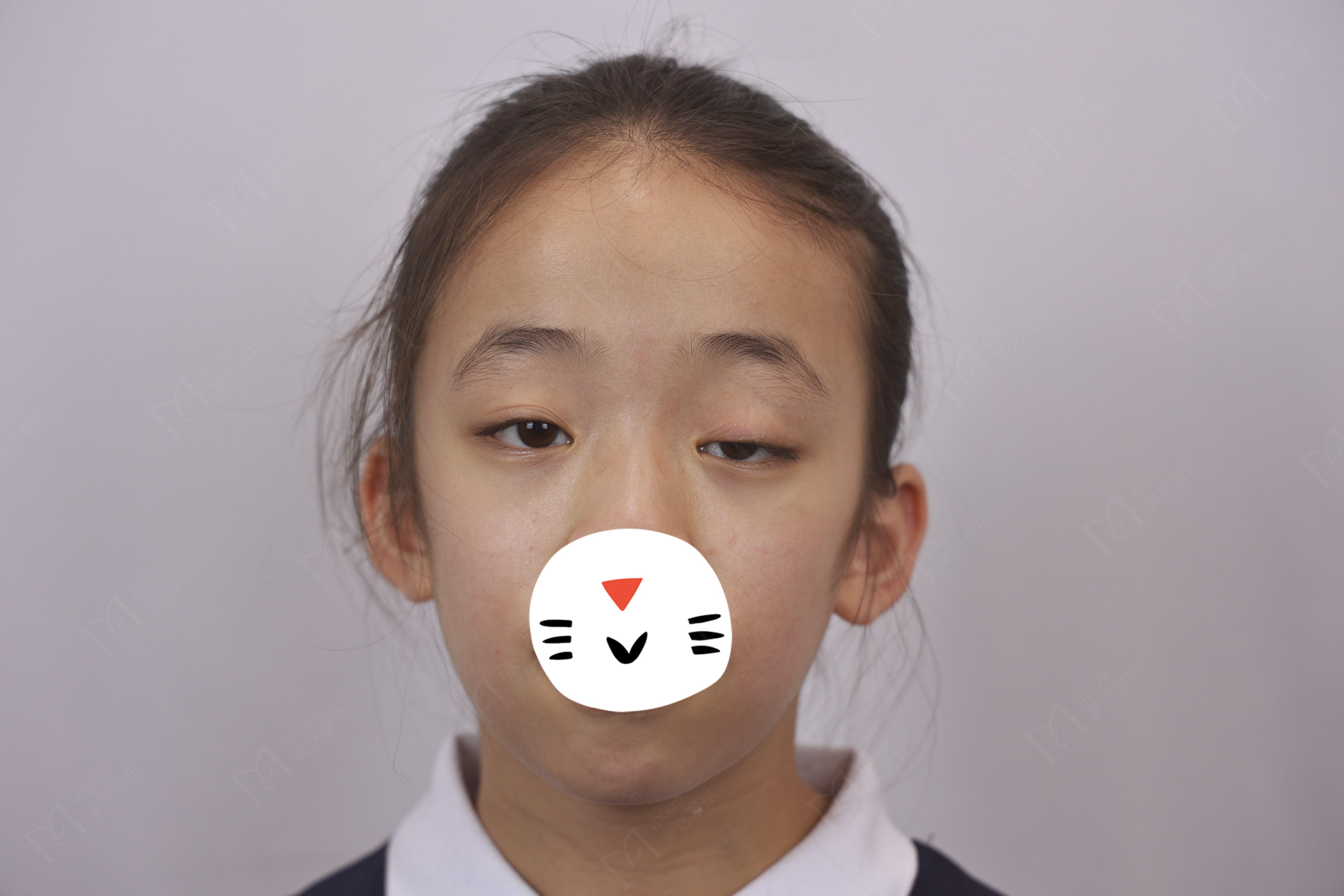 眼整形医生孔宇 的想法: 13岁小姑娘单侧先天性上睑下垂,我是如何给她