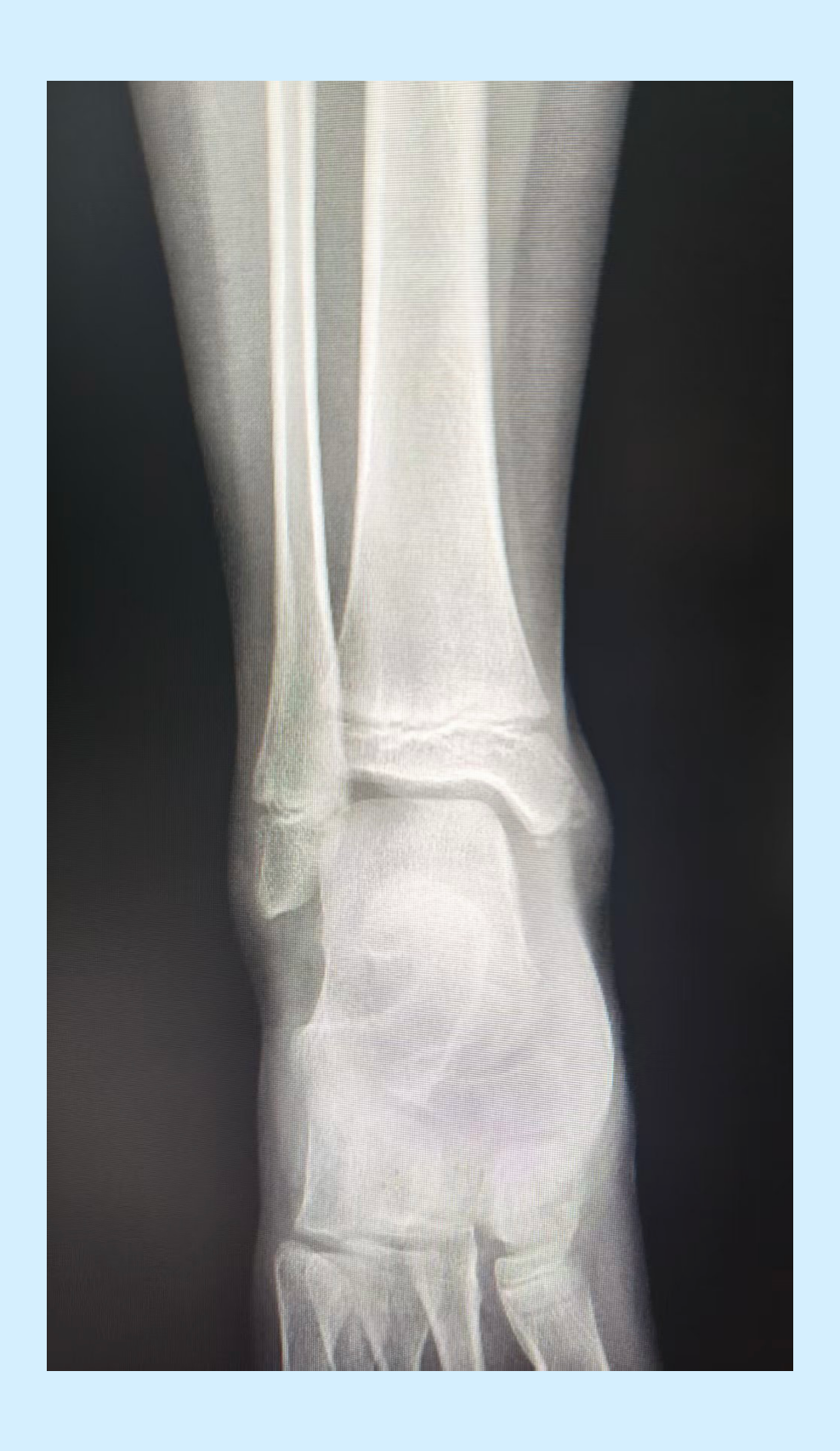 影像知识 的想法: 踝关节正侧位