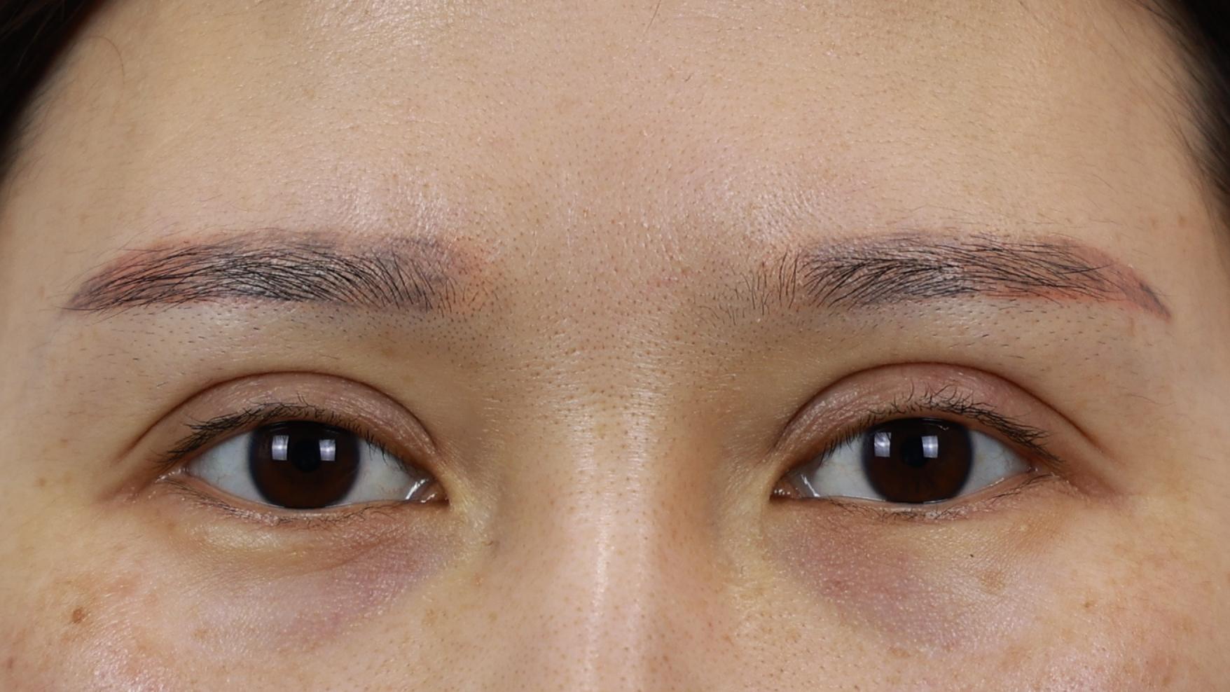 眼整形医生孔宇 的想法: 双眼皮太宽了并且闭眼痕迹明显怎么办?