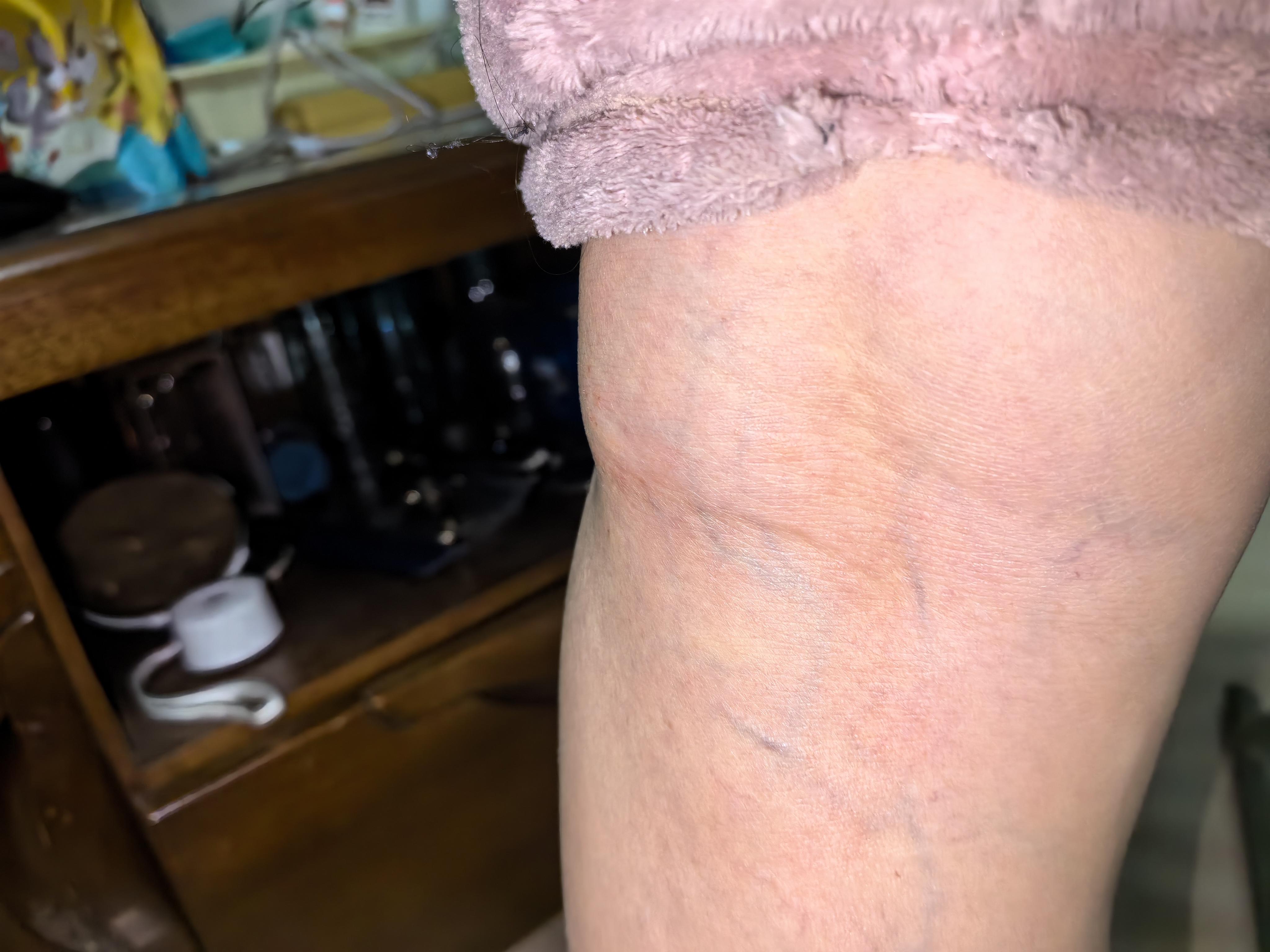 一脸肥羊 的想法: 腘窝囊肿 | <a class="hash_tag" href="