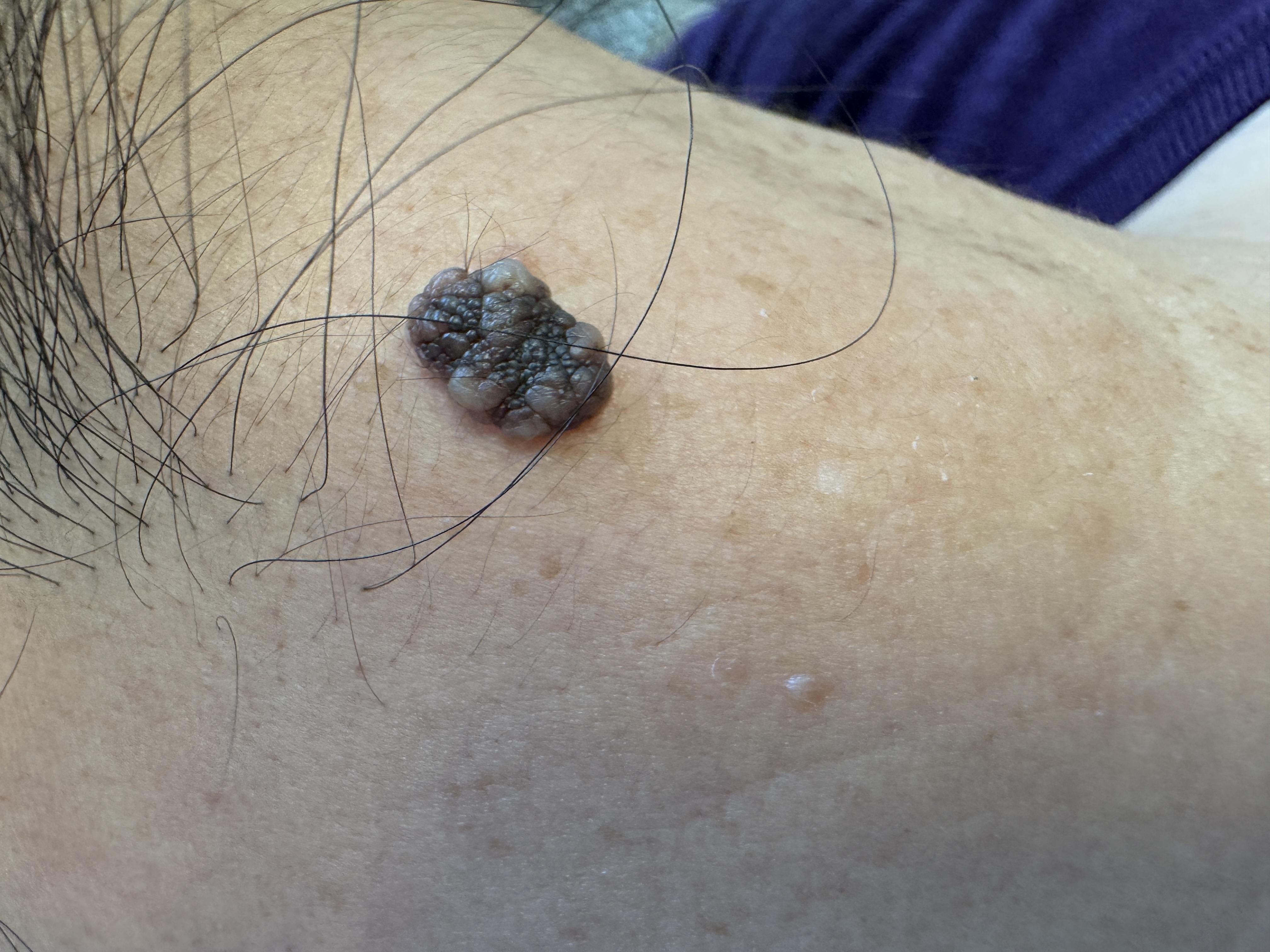 这位女士颈后的痣呈桑葚