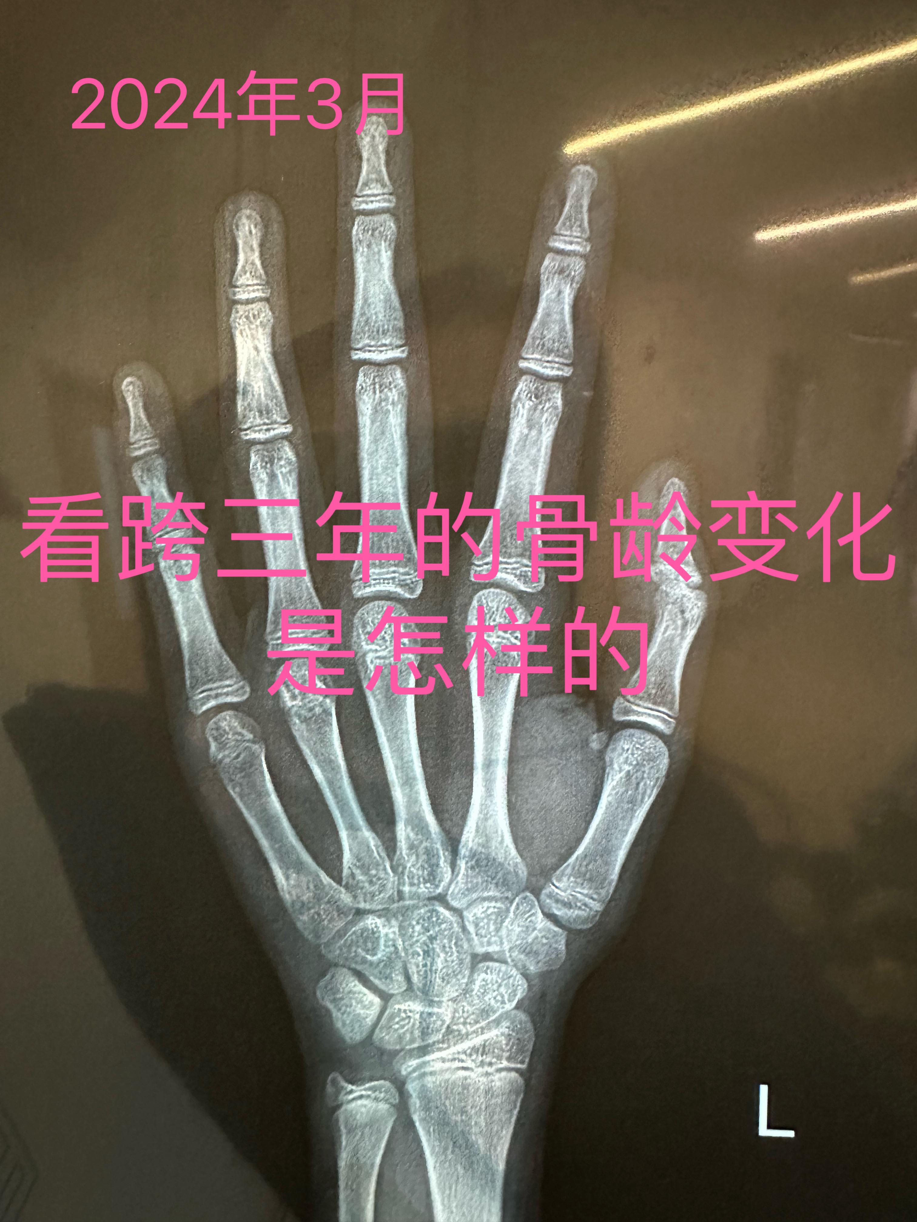 程军骨龄 的想法 跨三年的骨龄变化