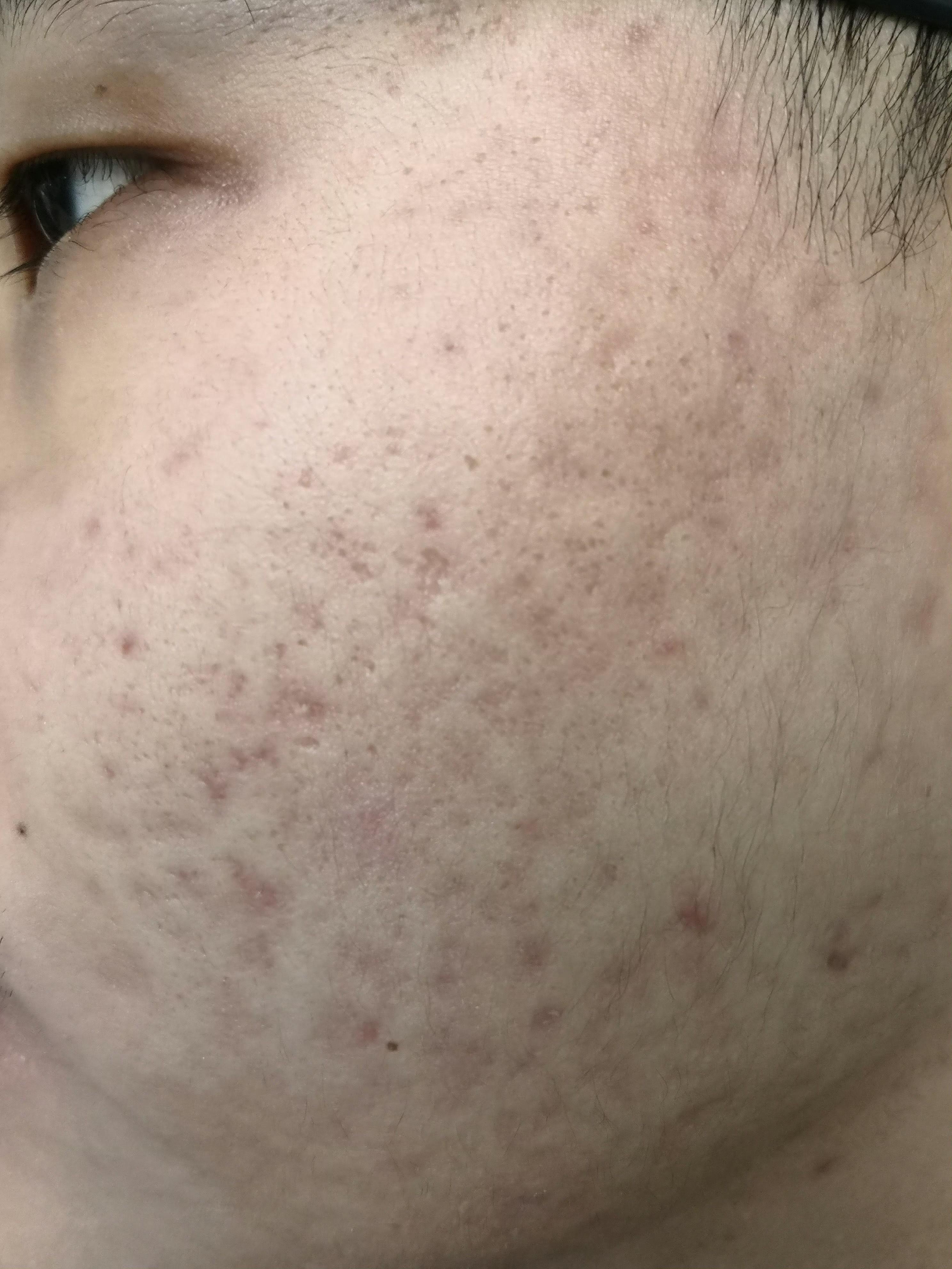 纪秀军主任医师 的想法: 痤疮痘坑痘印疤痕可以激光配合药物治疗